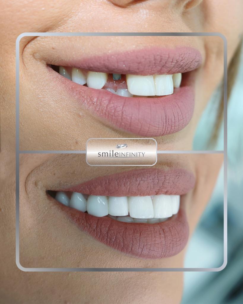 Dental implant crown before and after female — Smile Infinity® Beirut Lebanon