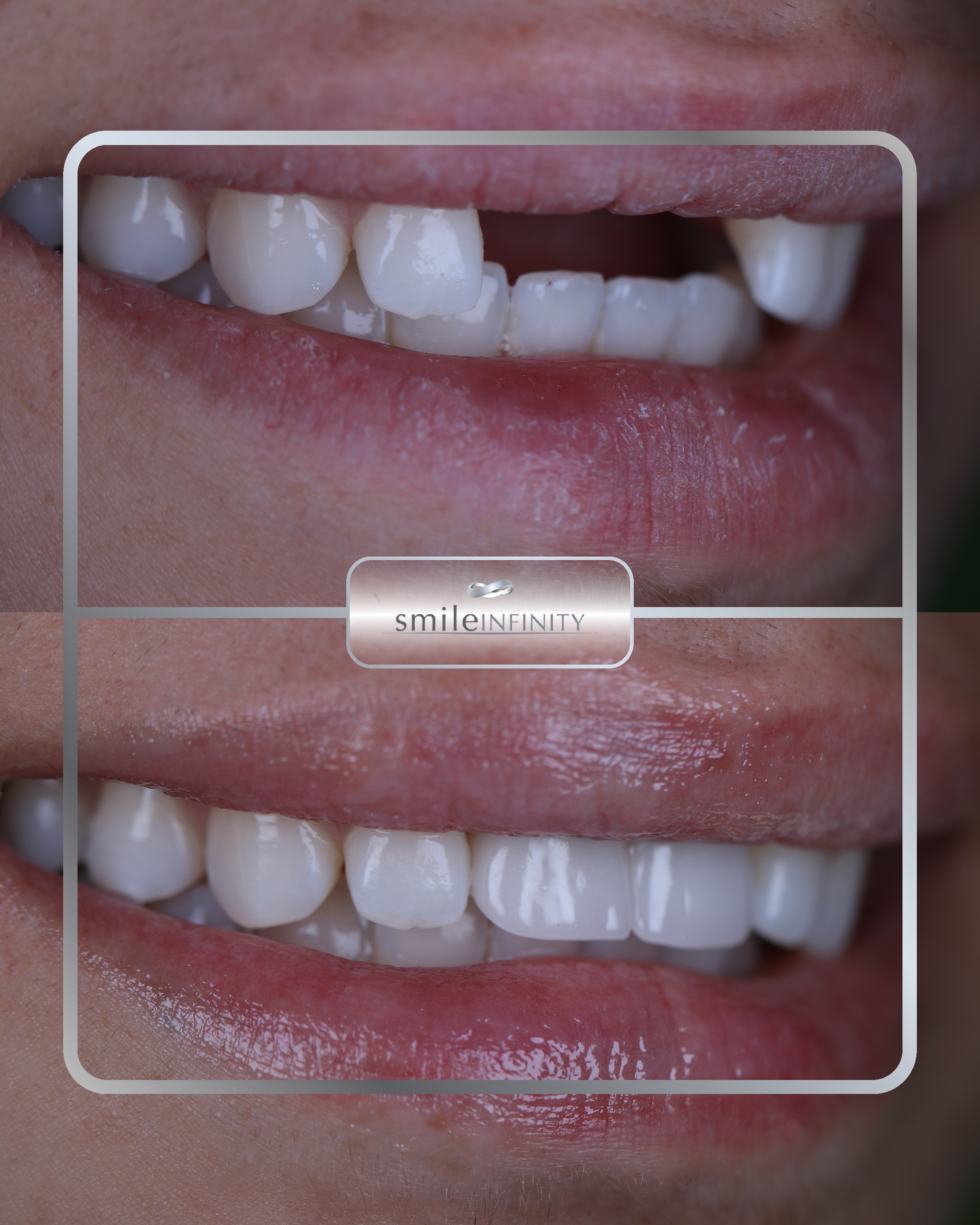 Dental implant single tooth before and after female — Ferrari Dental Lebanon