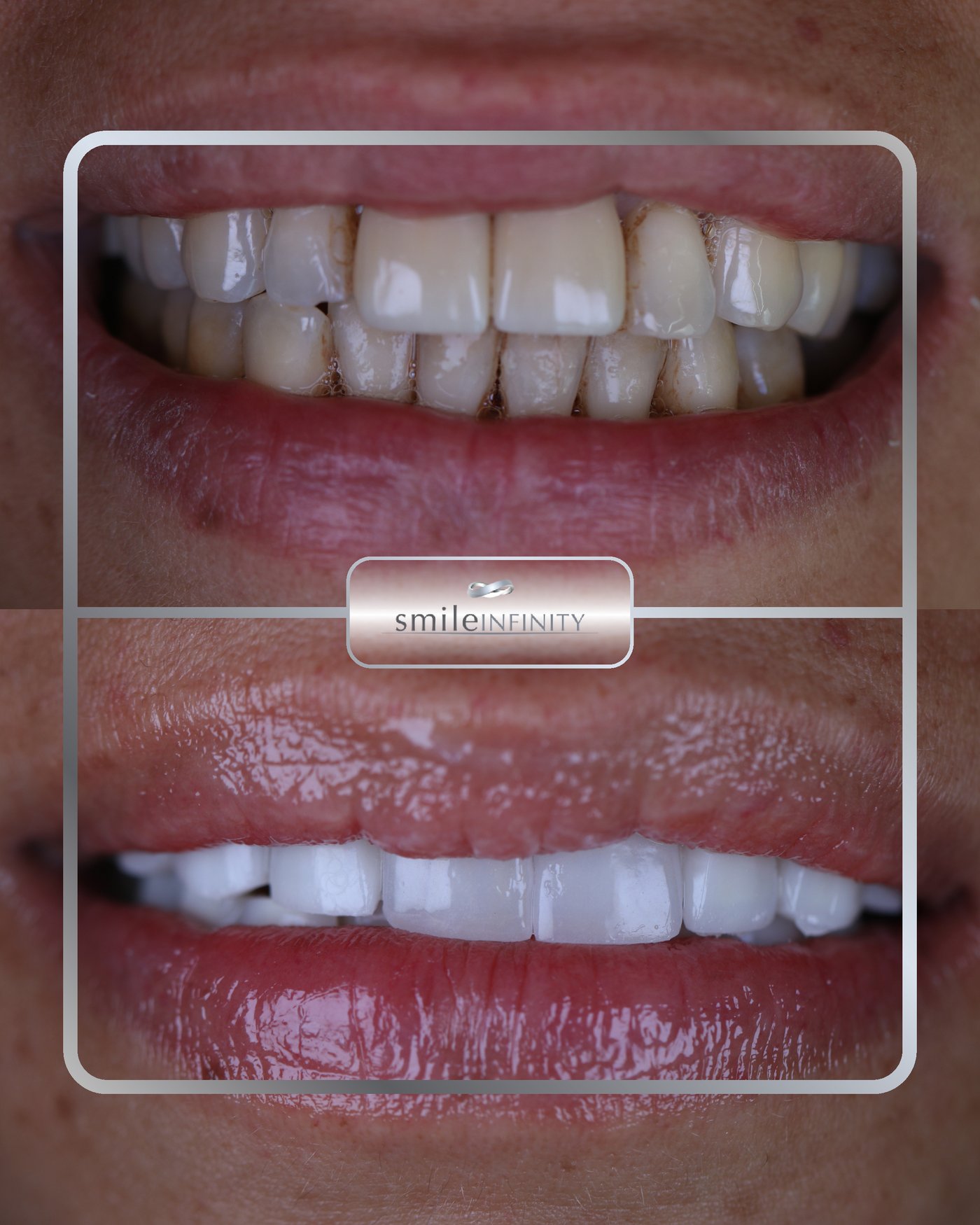 Emax ceramic veneers before and after female — Smile Infinity® Ferrari Dental Lebanon