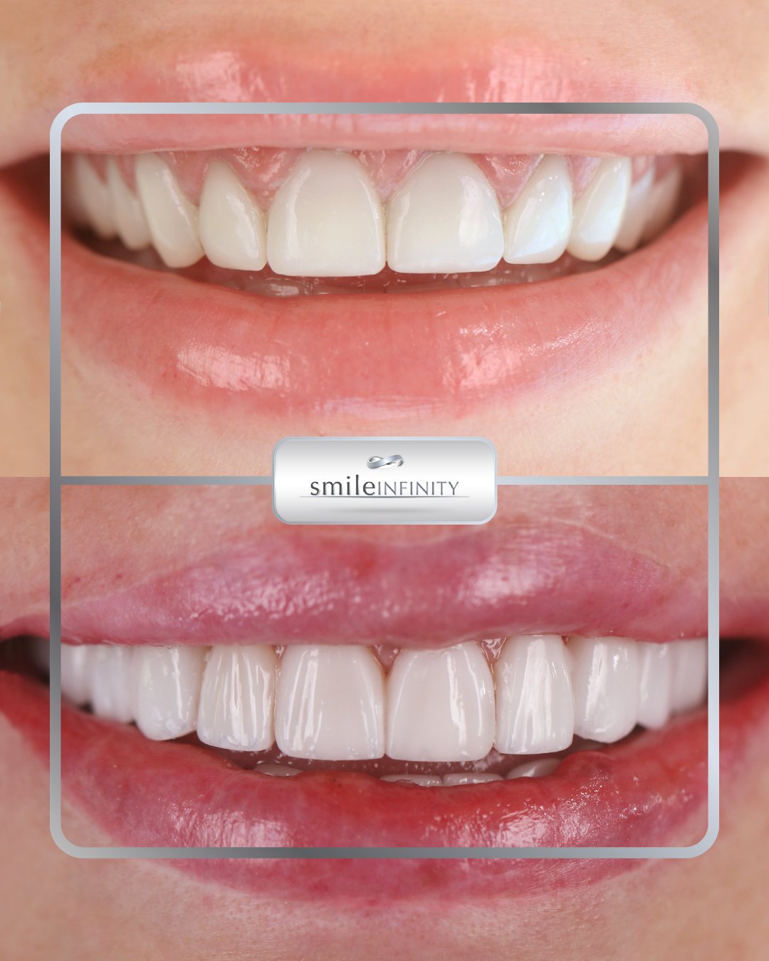 Emax ceramic veneers female result before and after — Ferrari Dental Lebanon