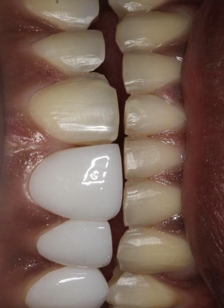 Emax single veneer placement comparison — Smile Infinity® Lebanon by Dr. Maya Zaeidan Zarifeh