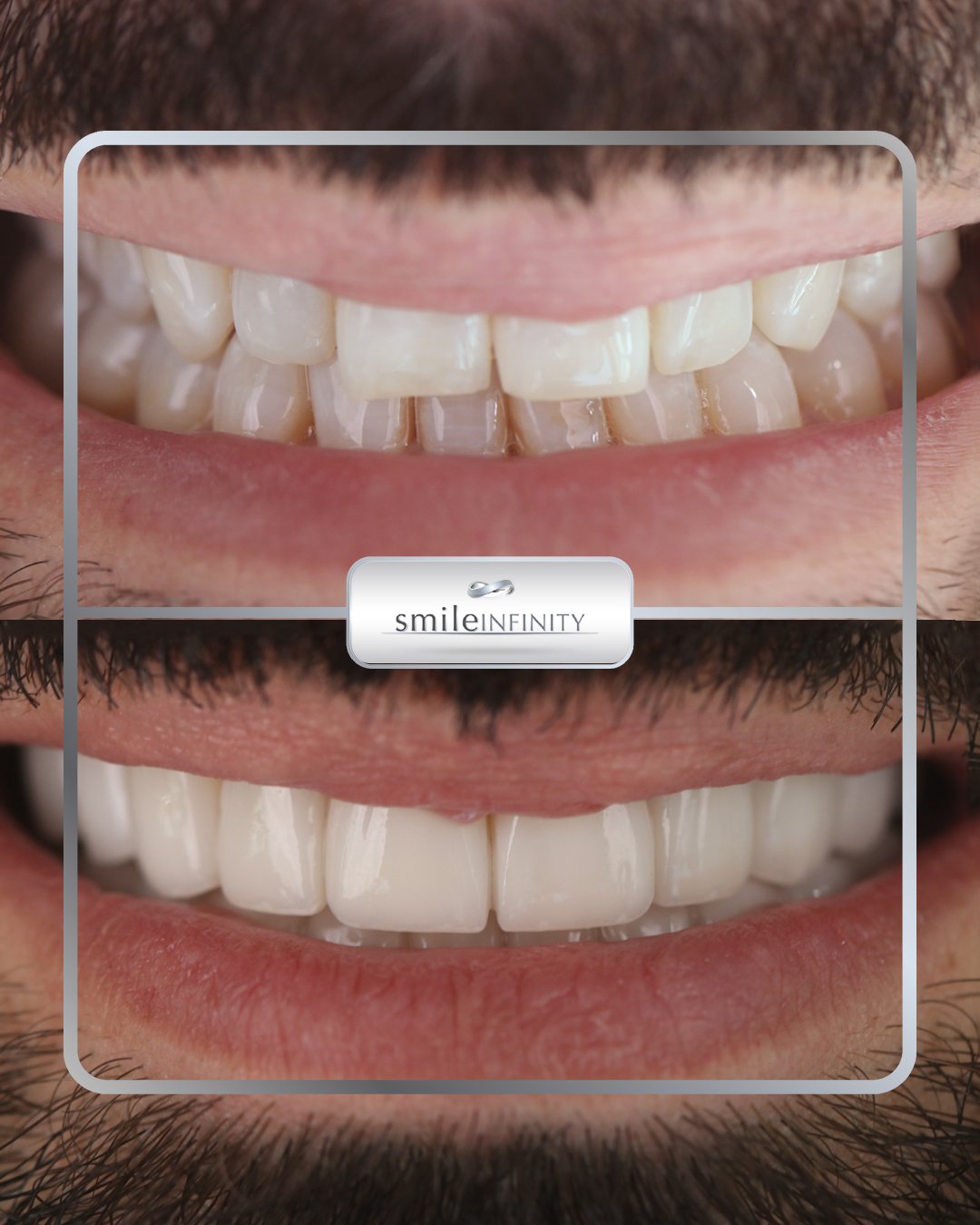 Emax veneers CAD/CAM before and after — Smile Infinity® Beirut Lebanon