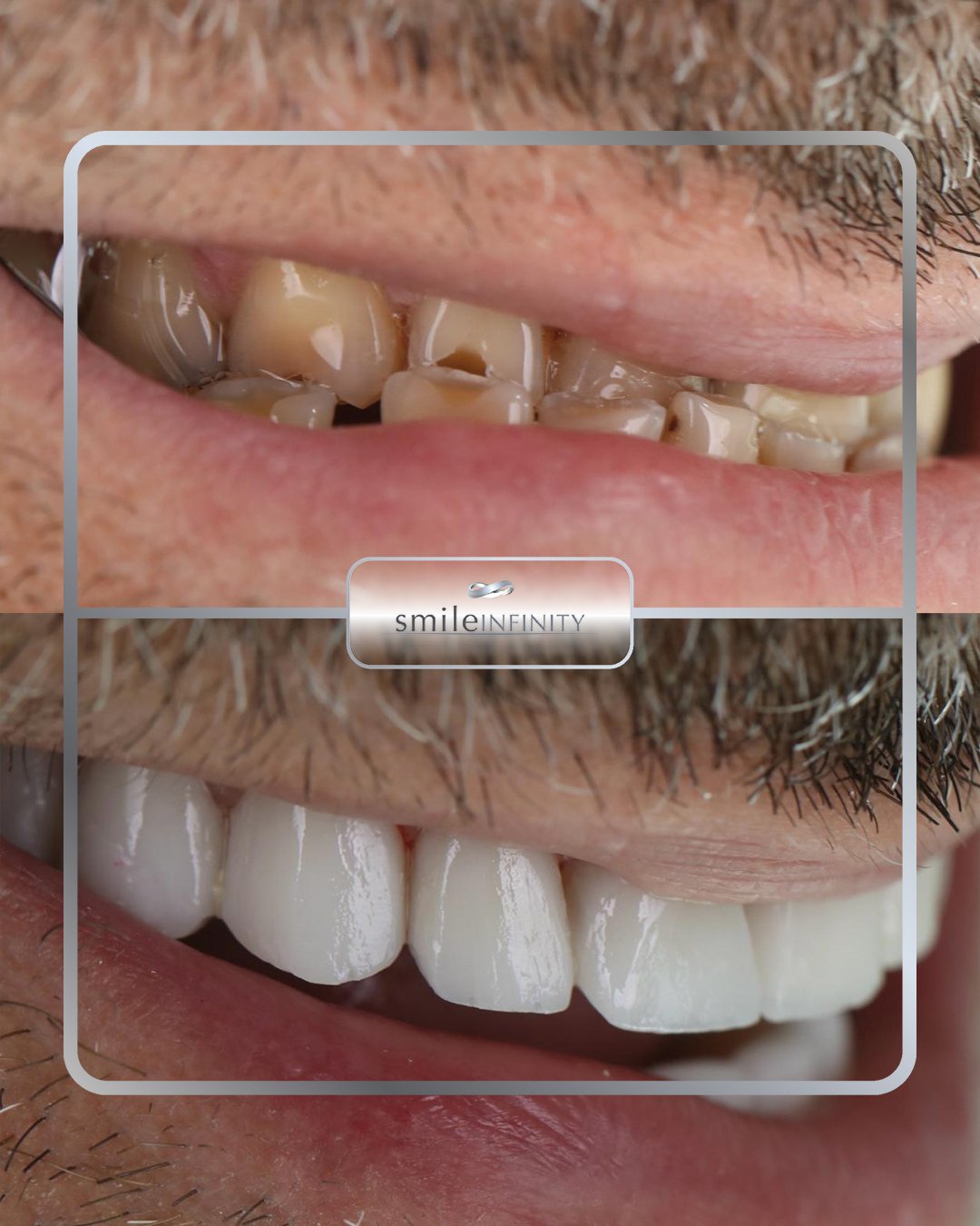 Emax veneers complex restoration before and after — Dr. Habib Zarifeh Beirut Lebanon