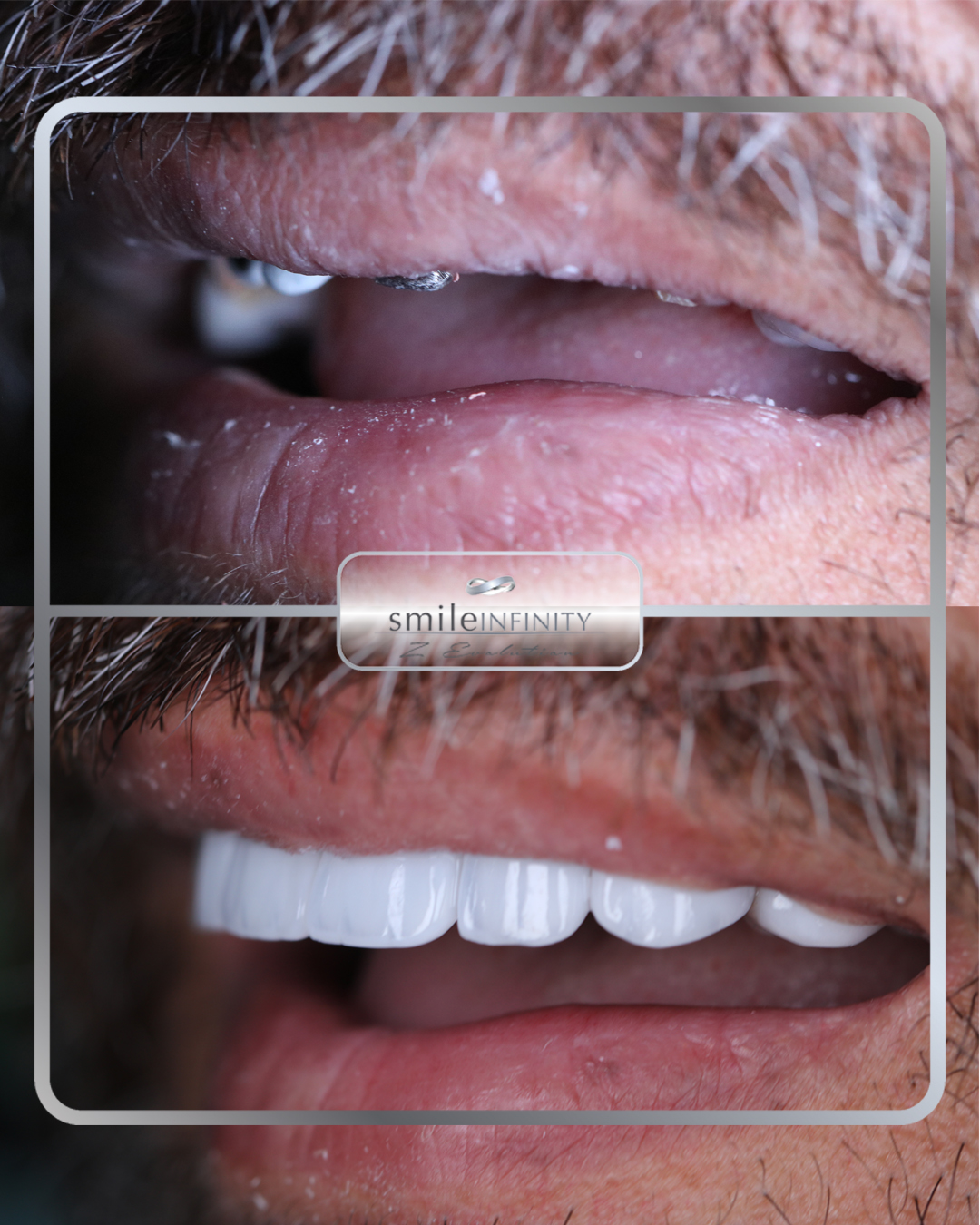 Full arch implant rehabilitation before and after male — Dr. Habib Zarifeh Lebanon