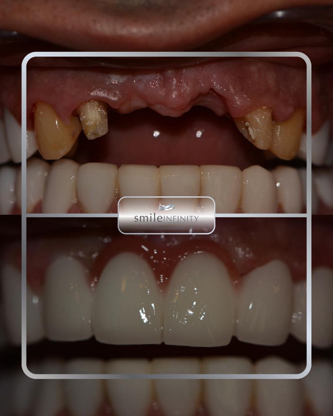Full mouth rehabilitation implants and veneers before and after — Smile Infinity® Lebanon