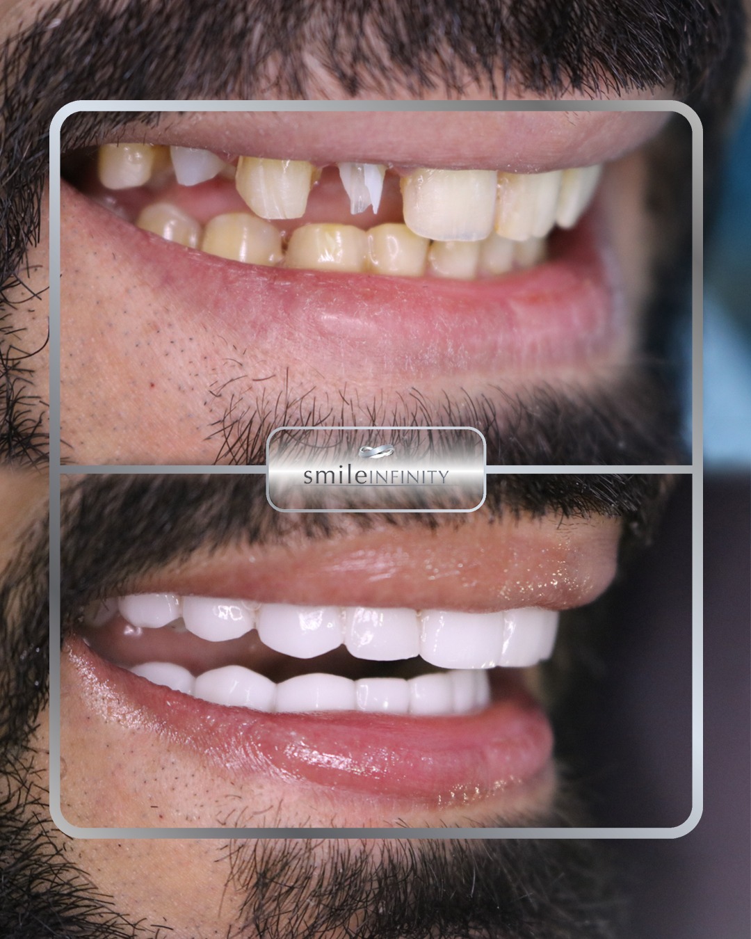 Hollywood Smile full arch before and after male — Smile Infinity® Beirut Lebanon