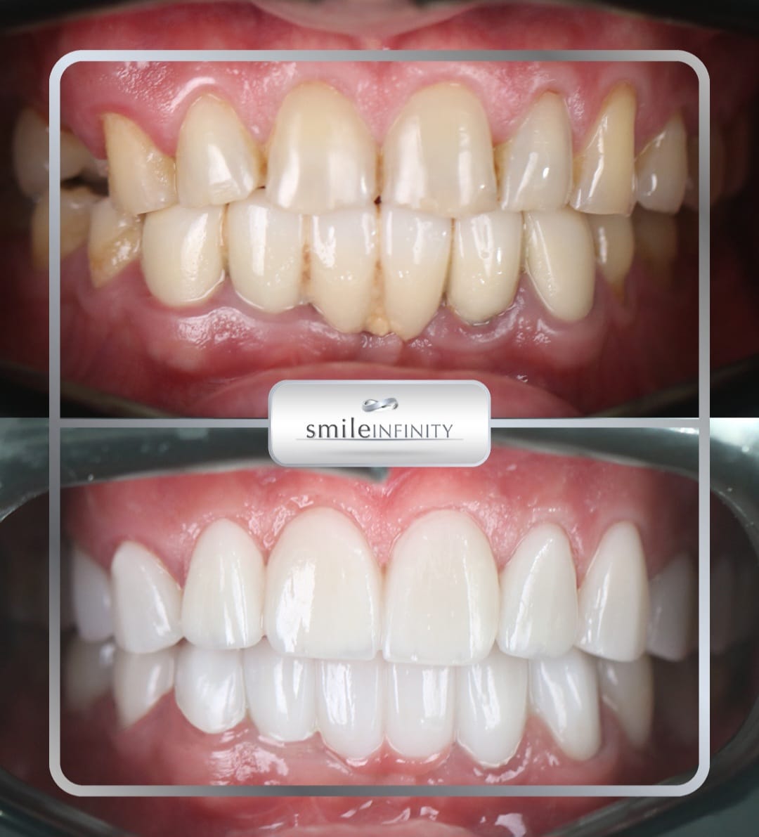 Hollywood Smile full arch veneers before and after — Ferrari Dental Lebanon, Dr. Habib Zarifeh