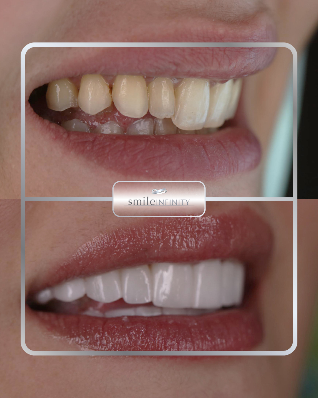 Hollywood Smile no-prep veneers before and after female — Smile Infinity® Lebanon