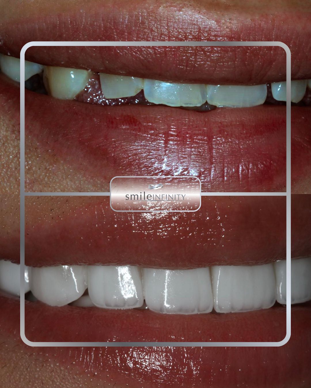 Hollywood Smile veneers before and after female — Smile Infinity® Ferrari Dental Lebanon