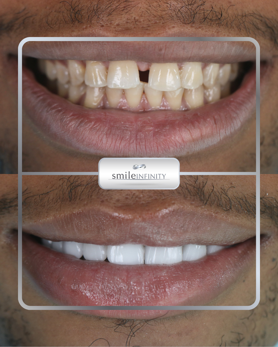Lumineers gap closure before and after male — Smile Infinity® Lebanon