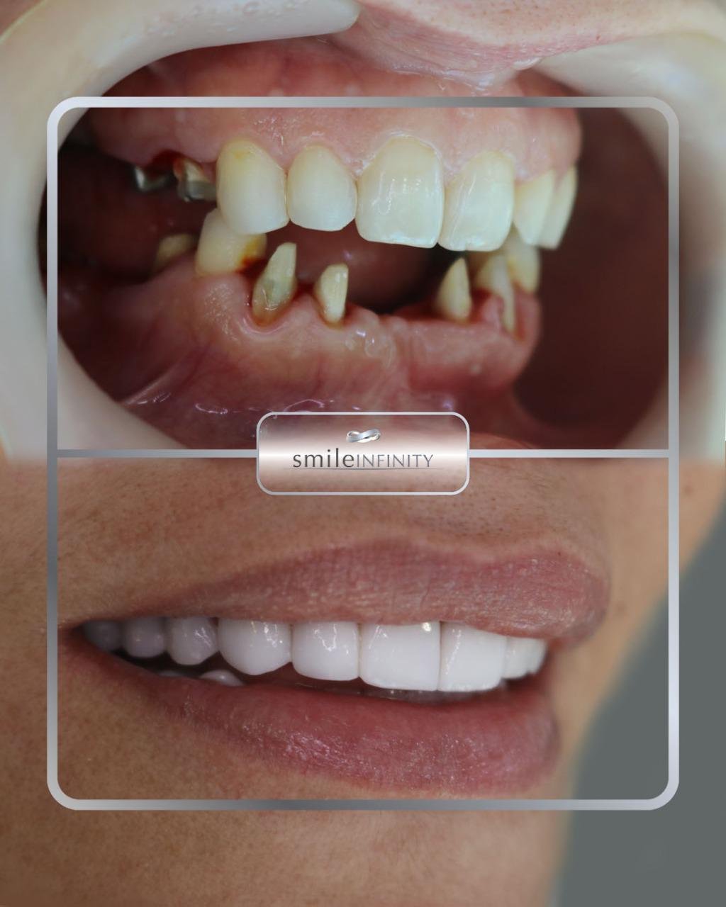 Oral surgery full mouth rehabilitation before and after female — Ferrari Dental Lebanon