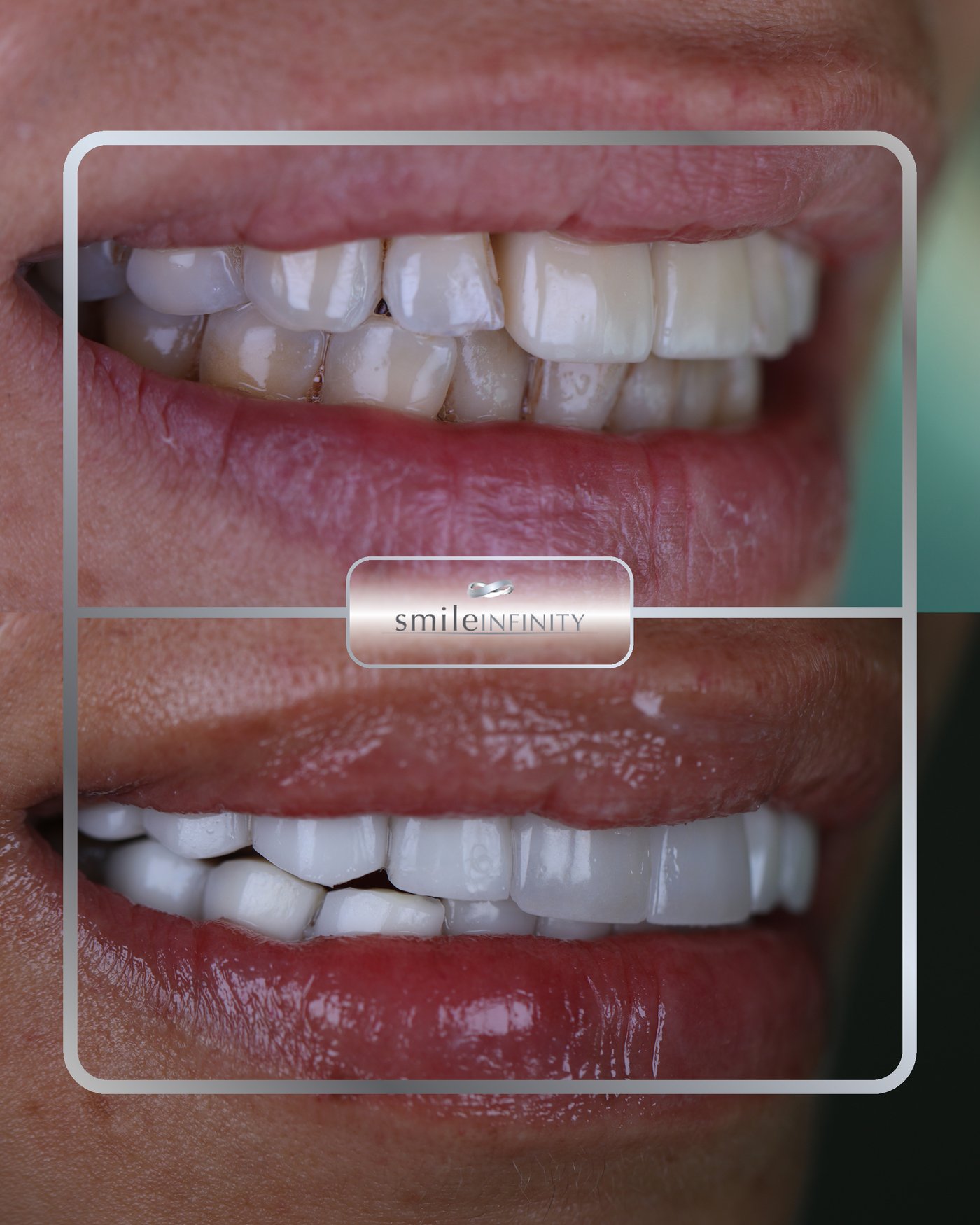 ZEvolution Veneers smile transformation before and after — Ferrari Dental Lebanon, case 2