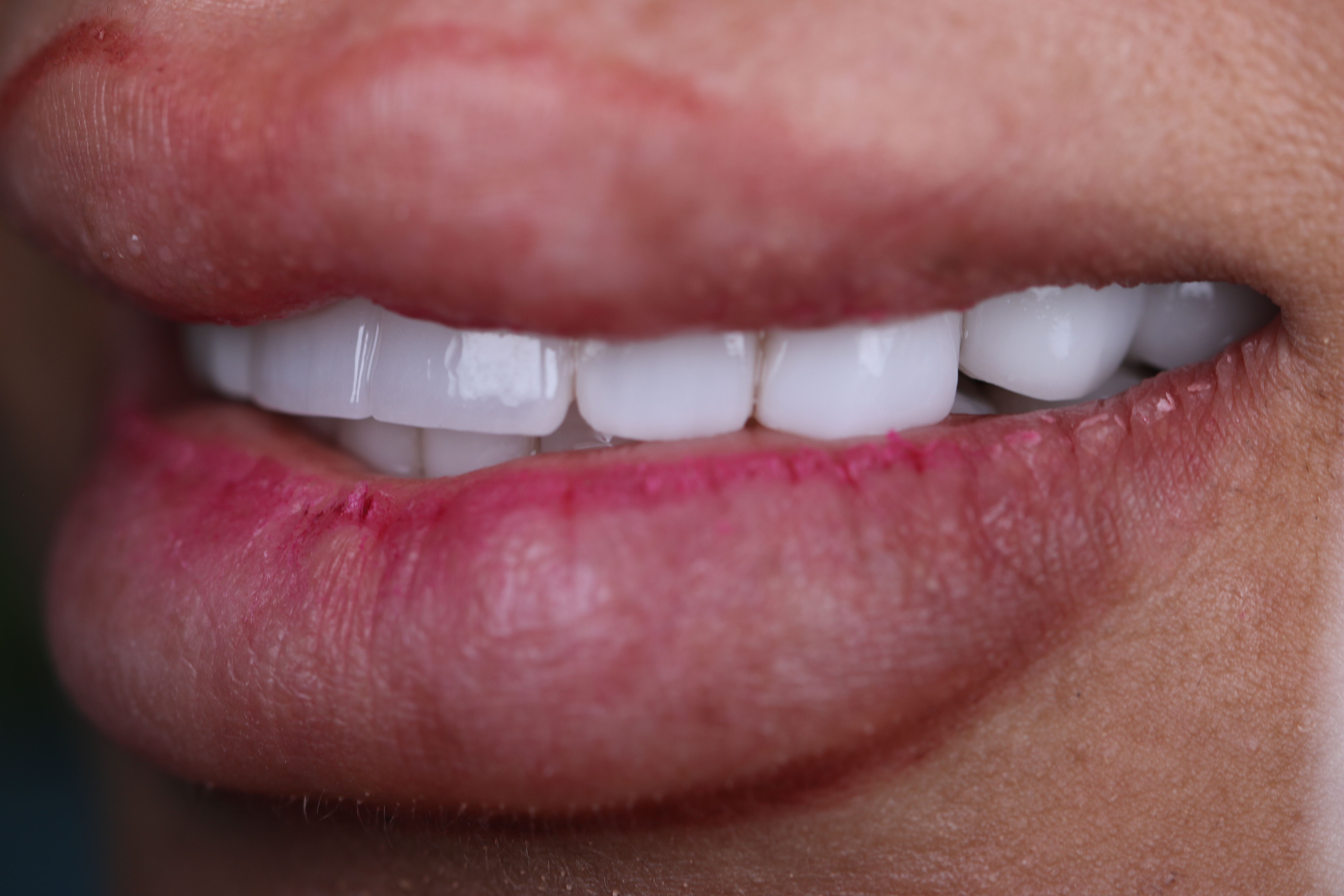 Dental implant after complete smile — female patient, Smile Infinity® Lebanon, Case 1