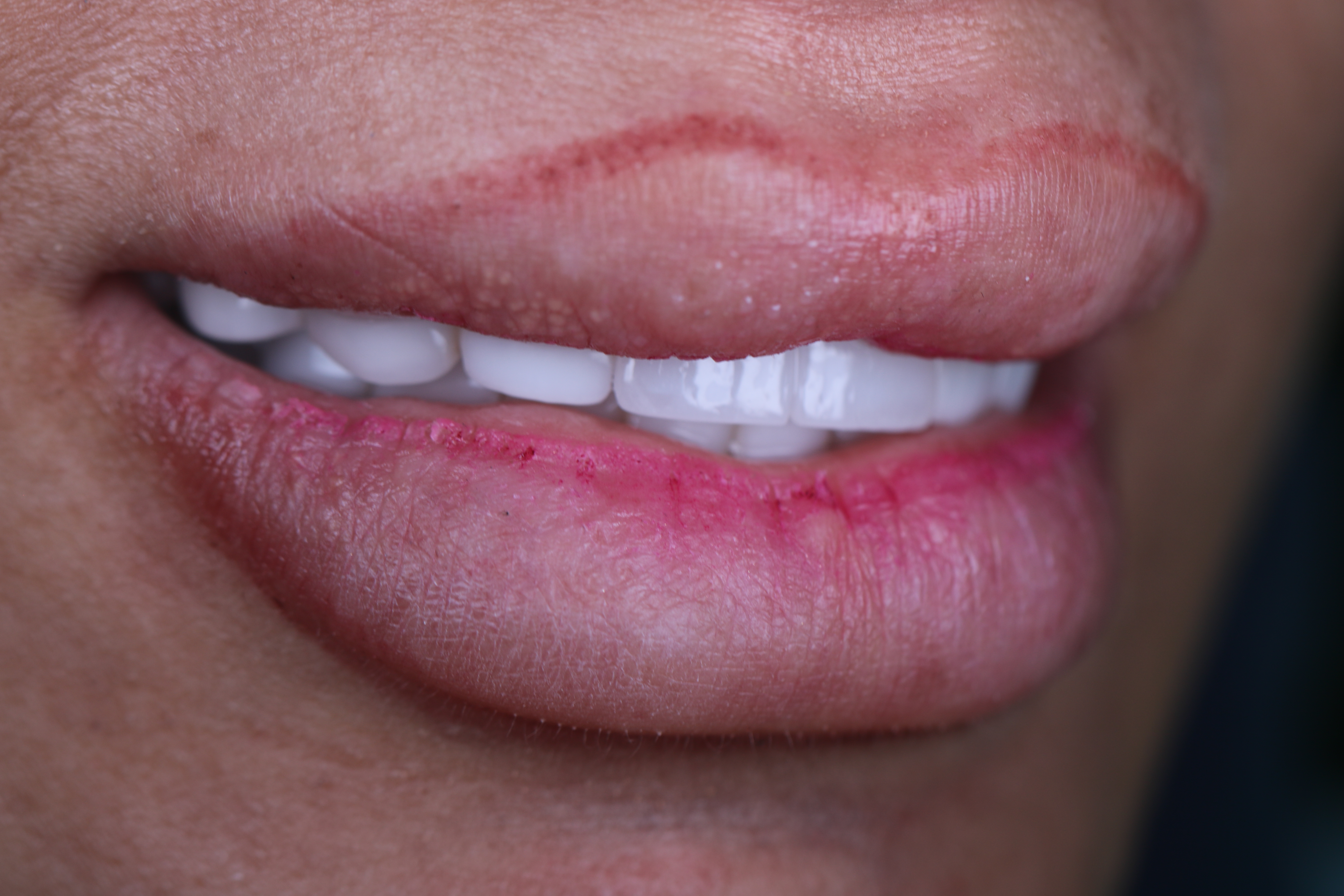 Dental implant after crown placed — smile, female patient, Smile Infinity® Lebanon, Case 1
