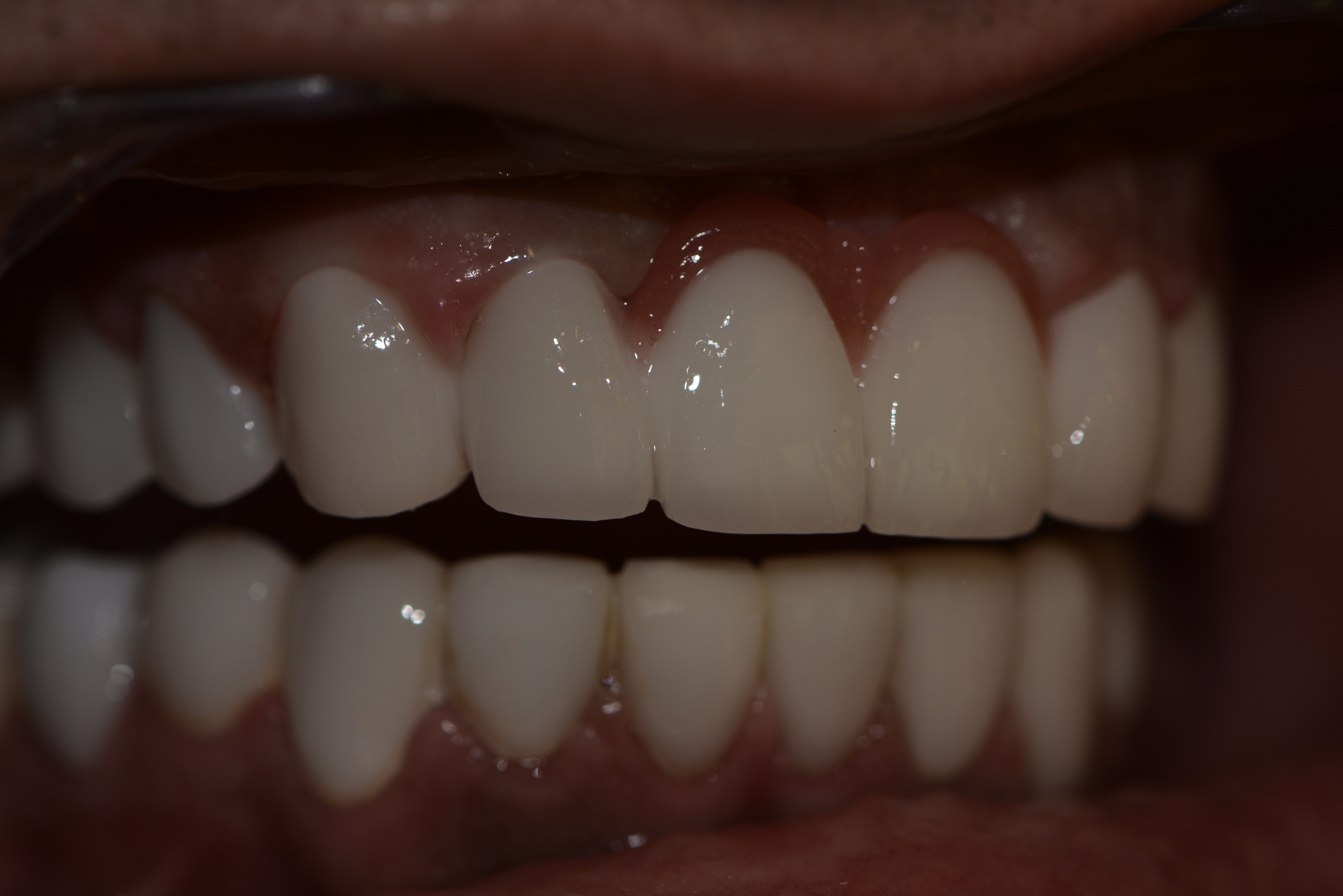 Dental implants after — full arch implant crowns, male patient, Smile Infinity® Lebanon, Case 2