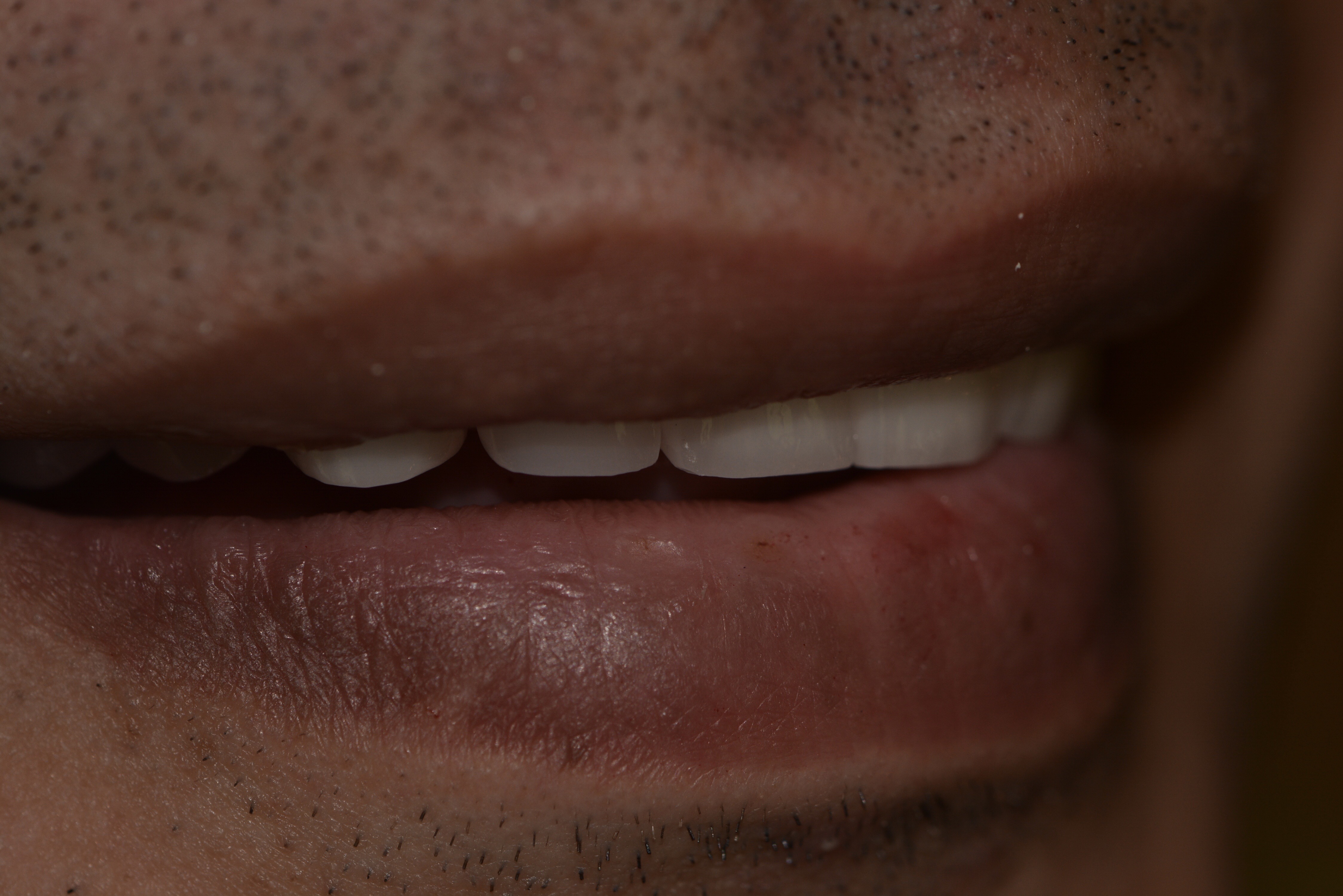 Dental implants after — restored smile, male patient, Smile Infinity® Lebanon, Case 2