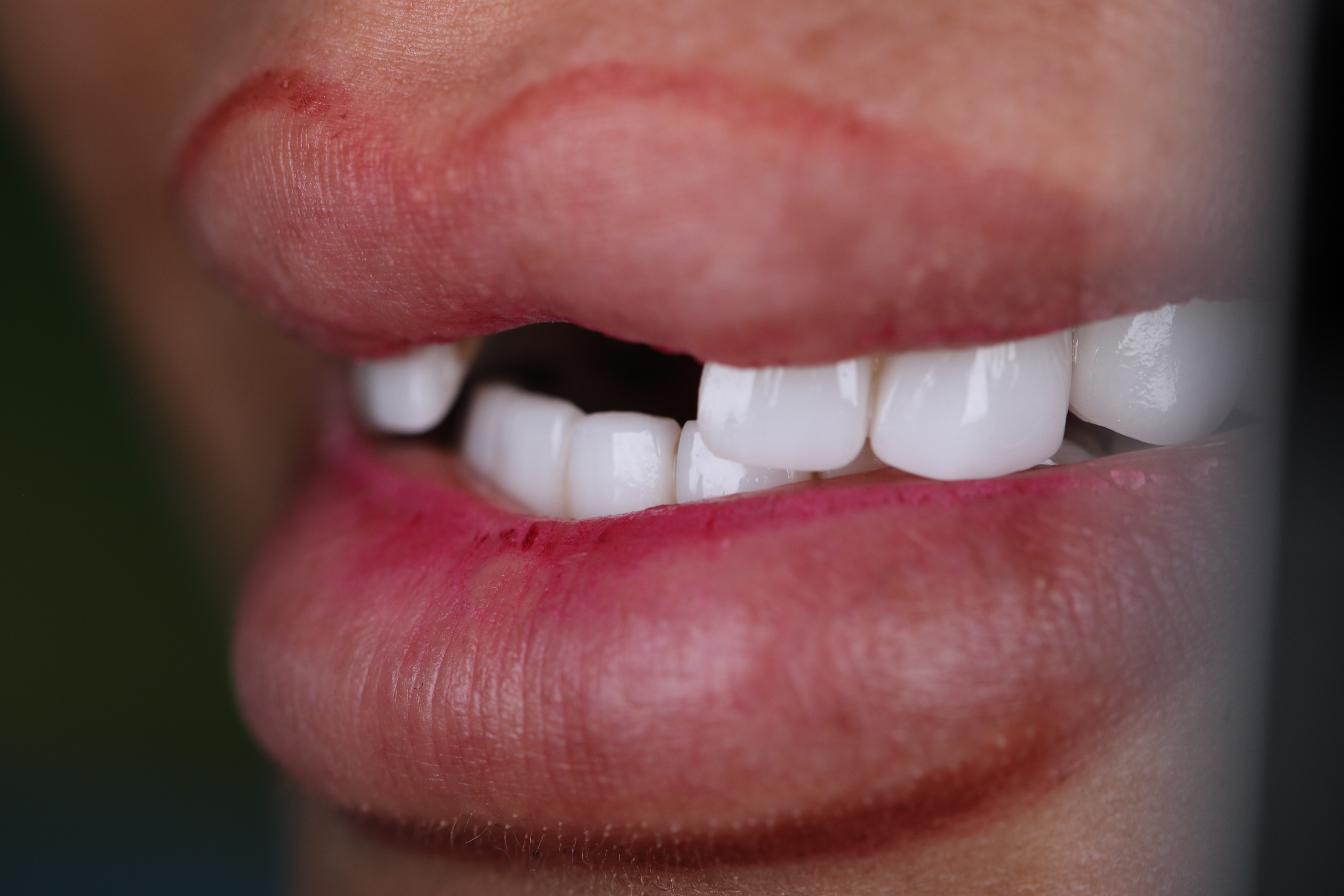Dental implant before — missing front tooth, female patient, Smile Infinity® Lebanon, Case 1
