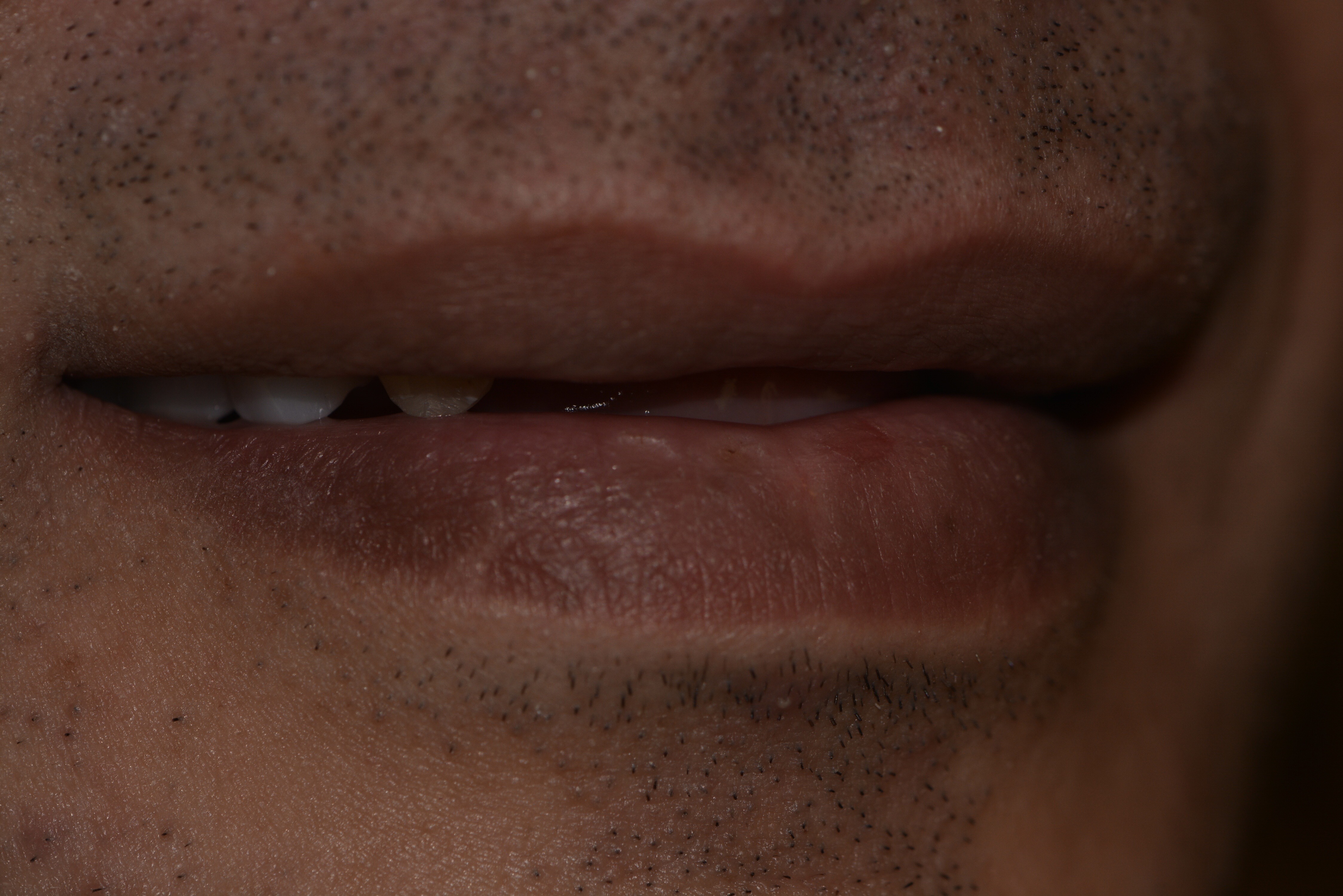 Dental implants before — missing teeth, male patient, Smile Infinity® Lebanon, Case 2