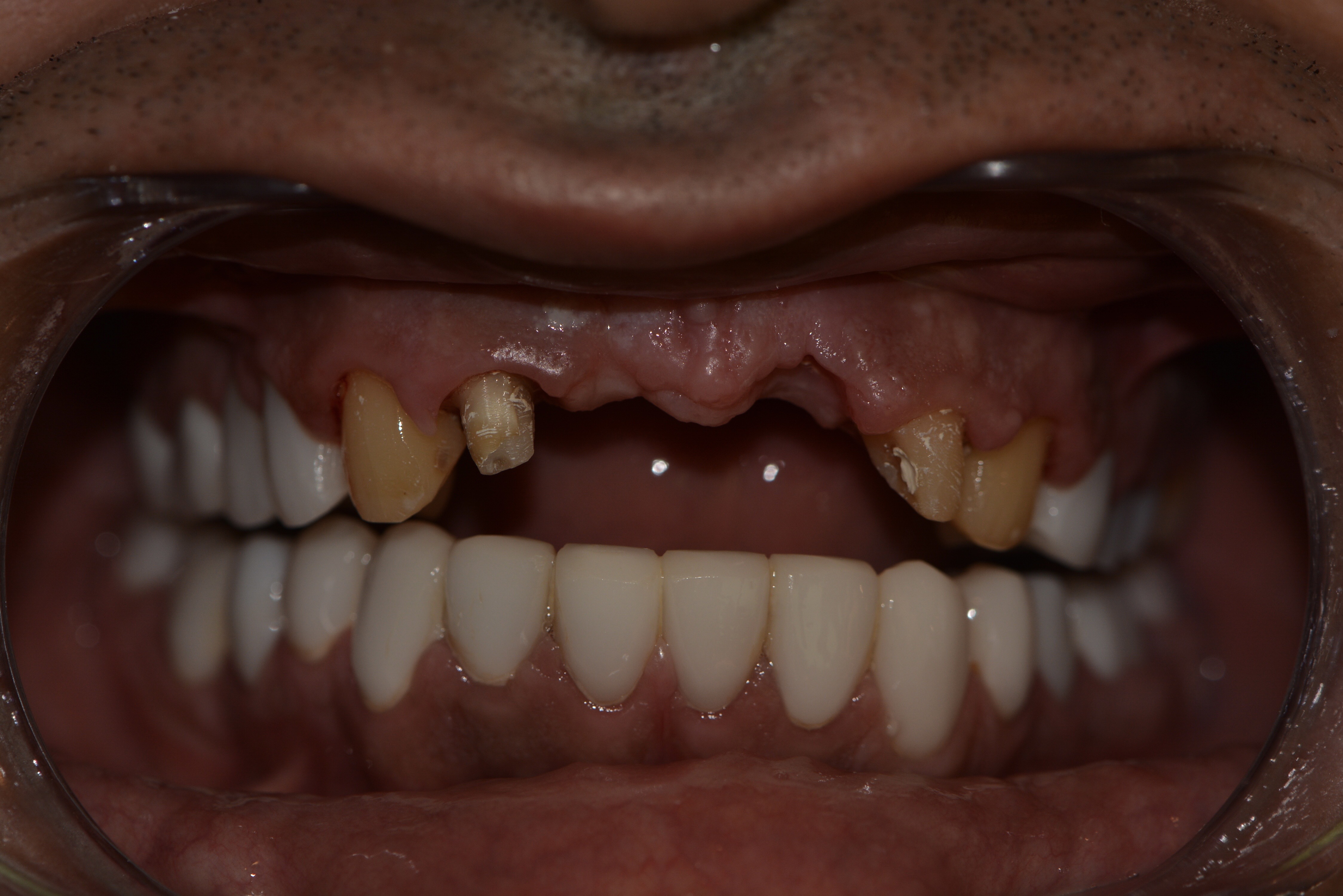Dental implants before — severe missing teeth with retractor, male patient, Smile Infinity® Lebanon, Case 2