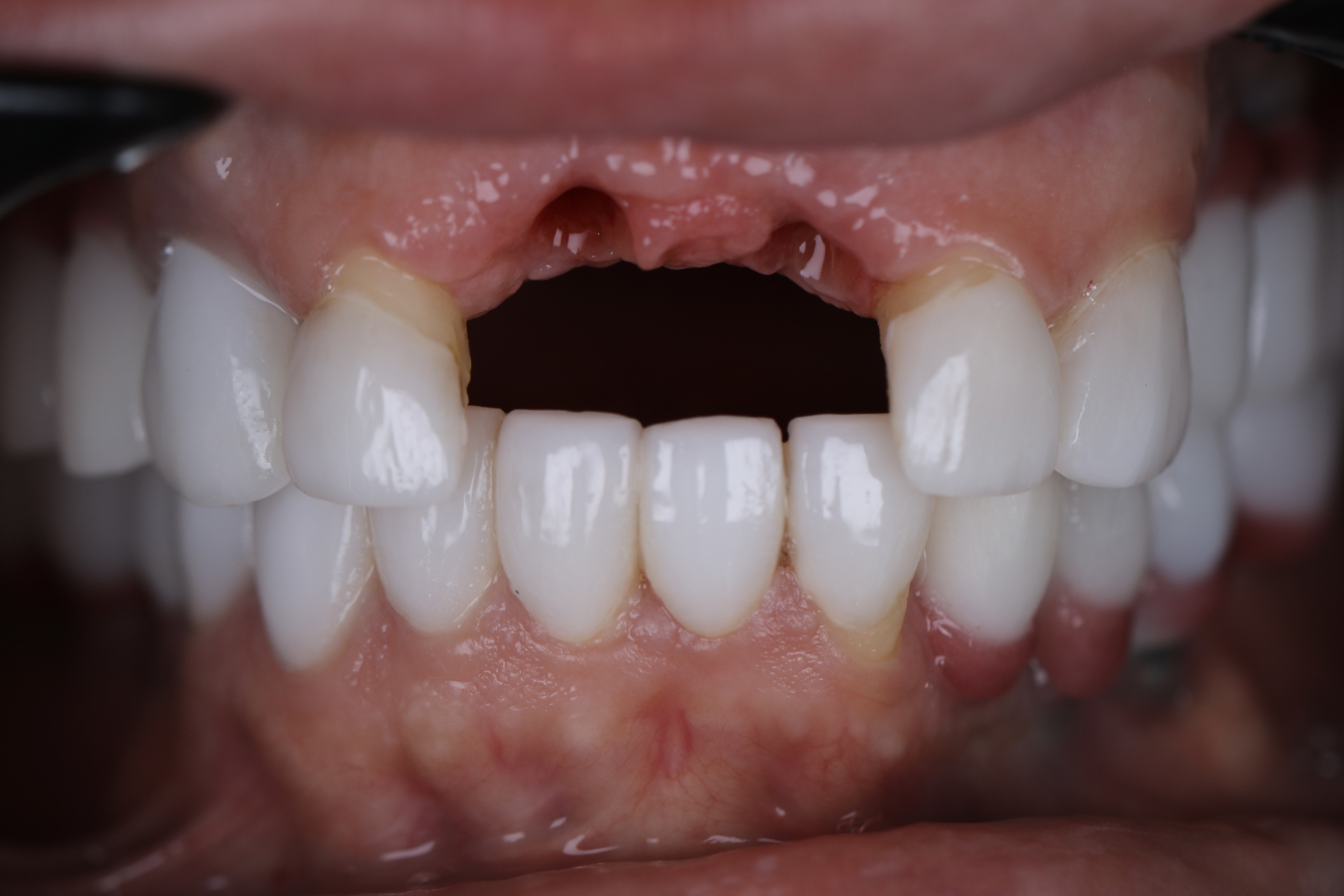Dental implant during abutment placement — female patient, Smile Infinity® Lebanon, Case 1