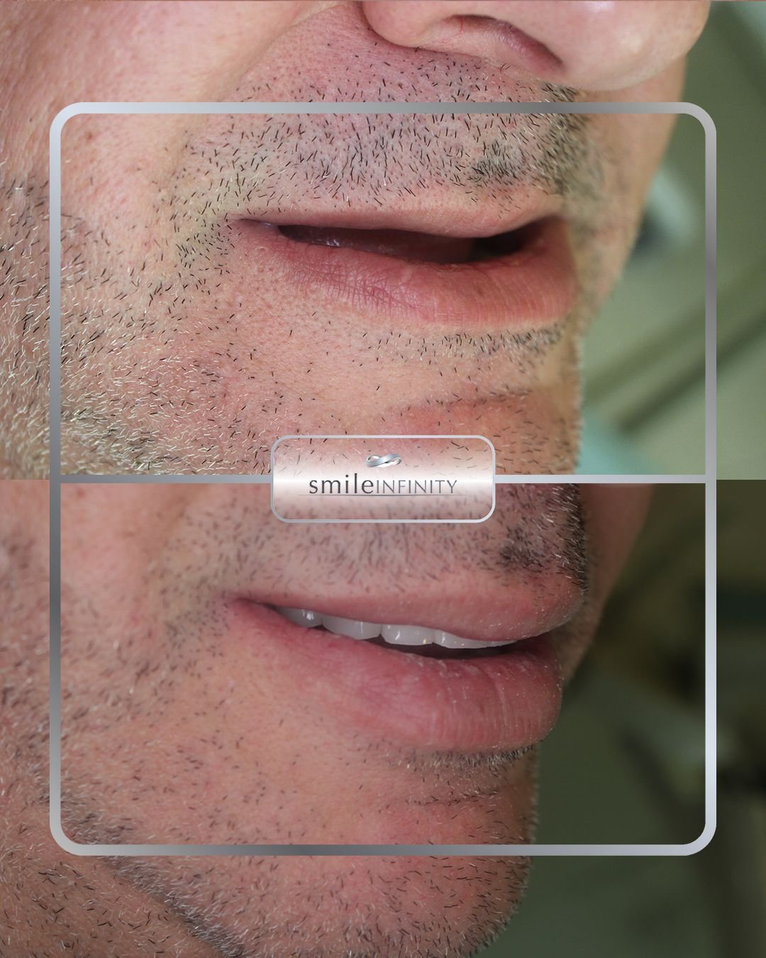 Dental implants restoration before and after — male patient, Smile Infinity® Beirut Lebanon