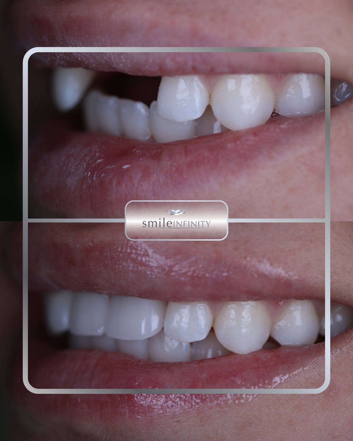 Single tooth dental implant before and after — female patient, Ferrari Dental Beirut Lebanon