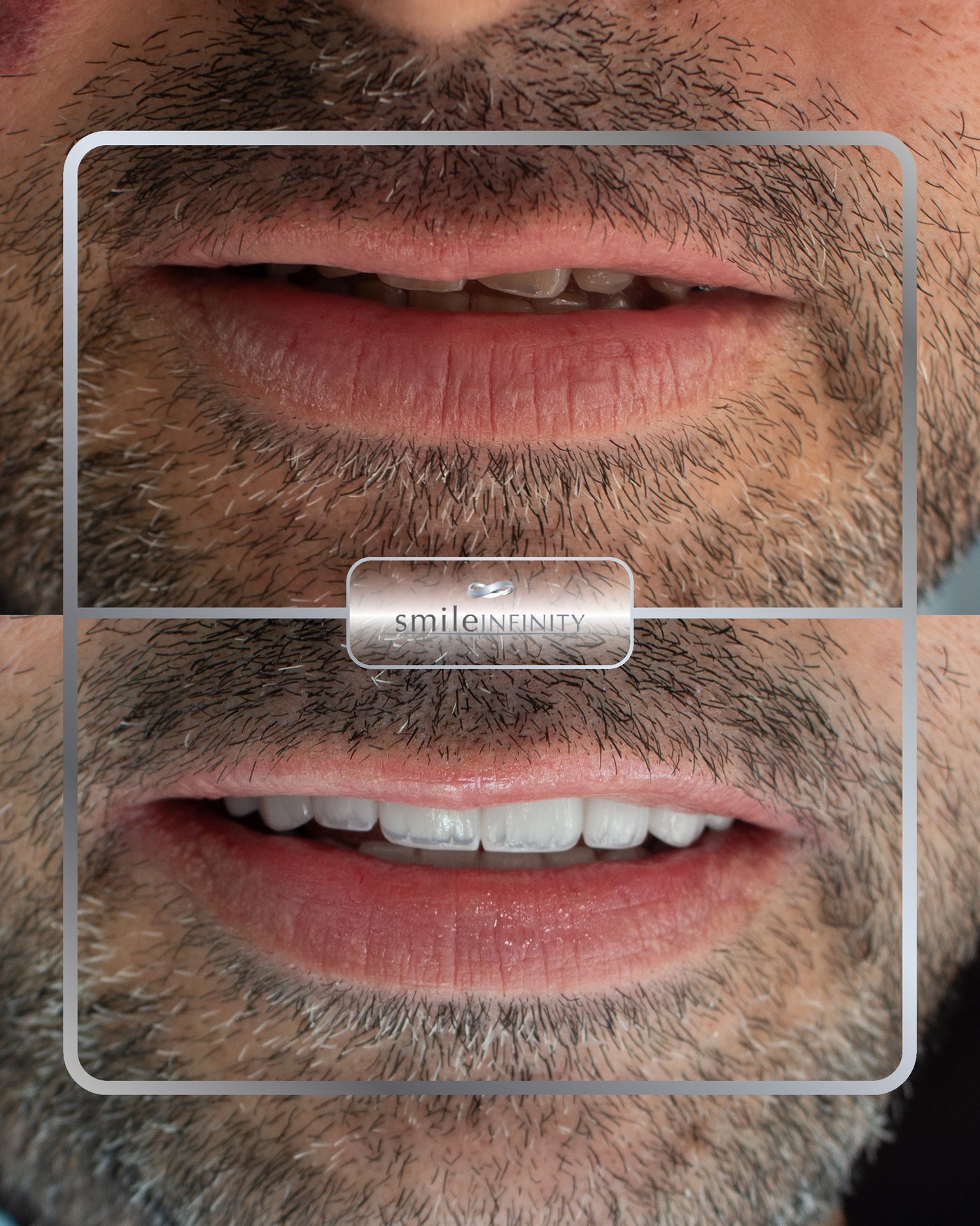 Emax veneers Hollywood Smile before and after — male patient, Ferrari Dental Beirut Lebanon