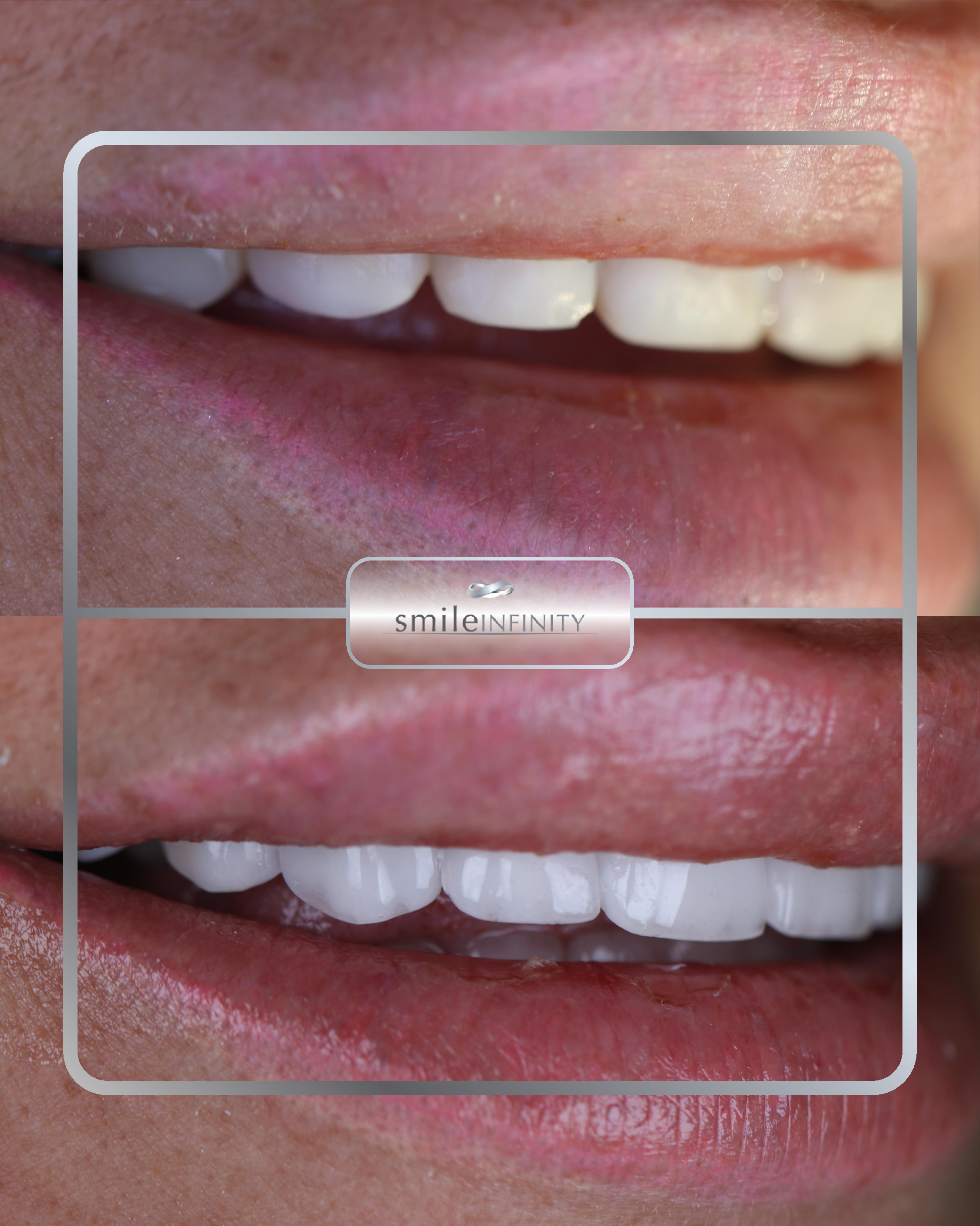 Hollywood Smile before and after — Smile Infinity® Lebanon