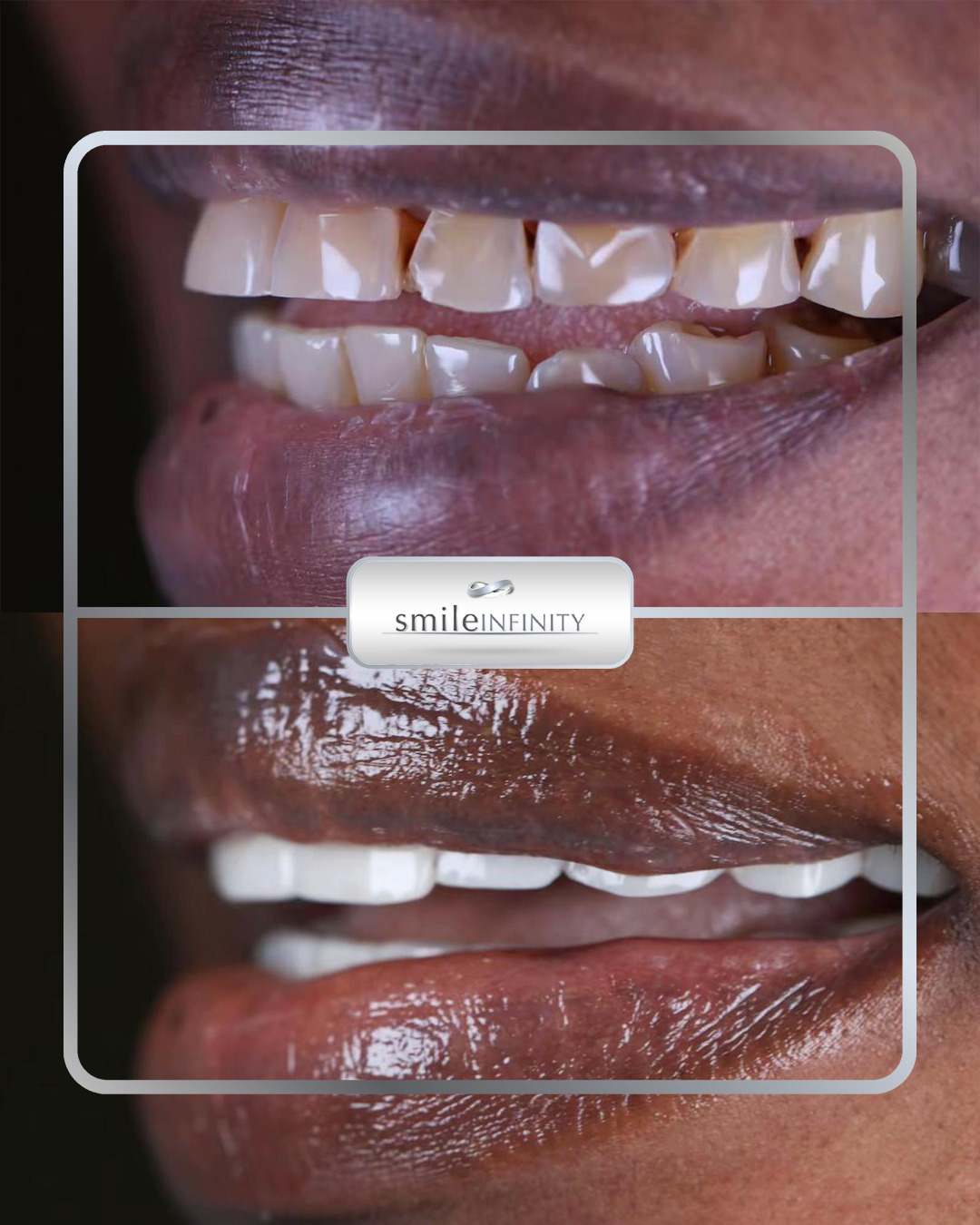 Hollywood Smile veneers before and after — Smile Infinity® Lebanon and Africa