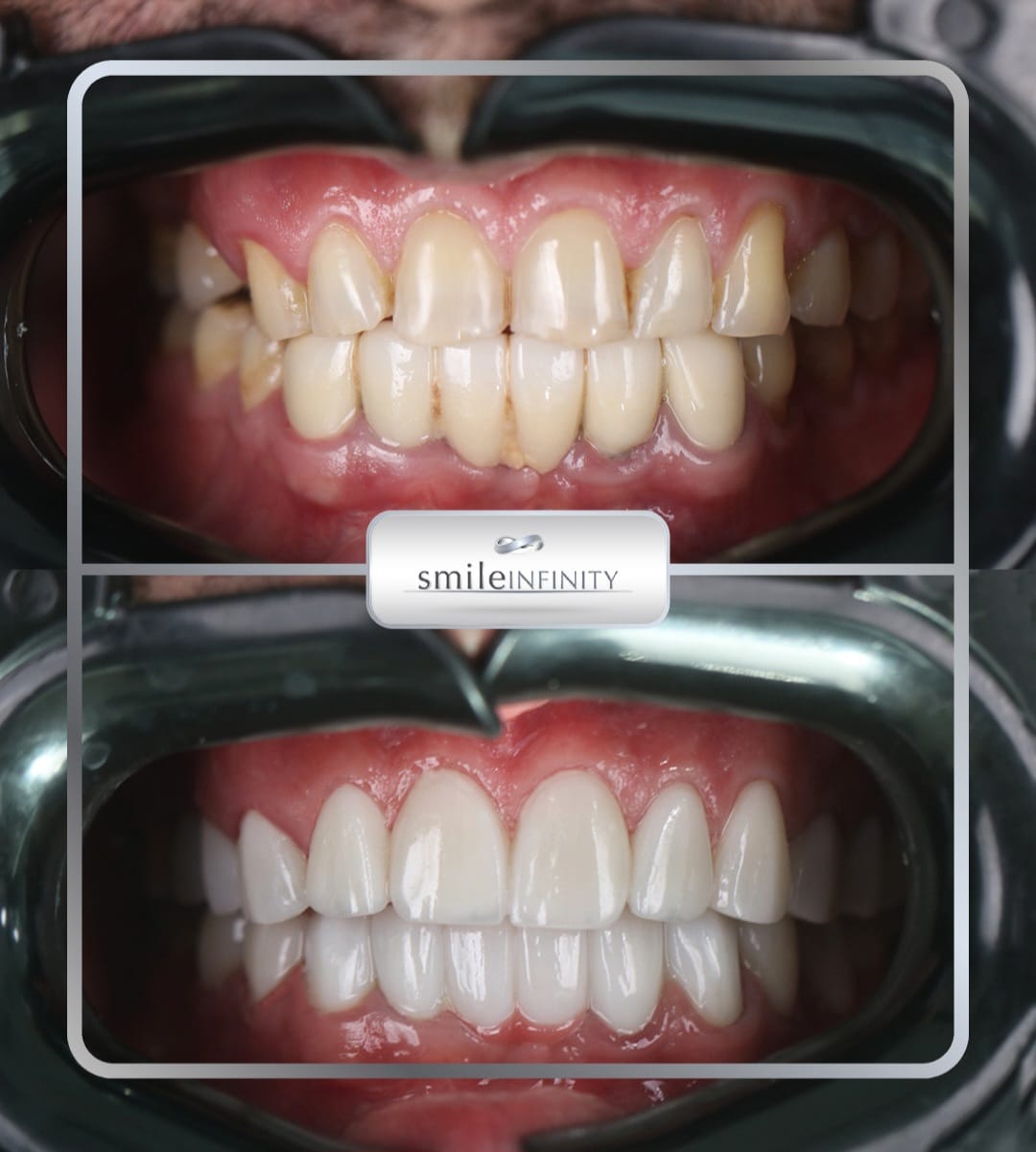 Lumineers full arch before and after — Smile Infinity® Beirut Lebanon