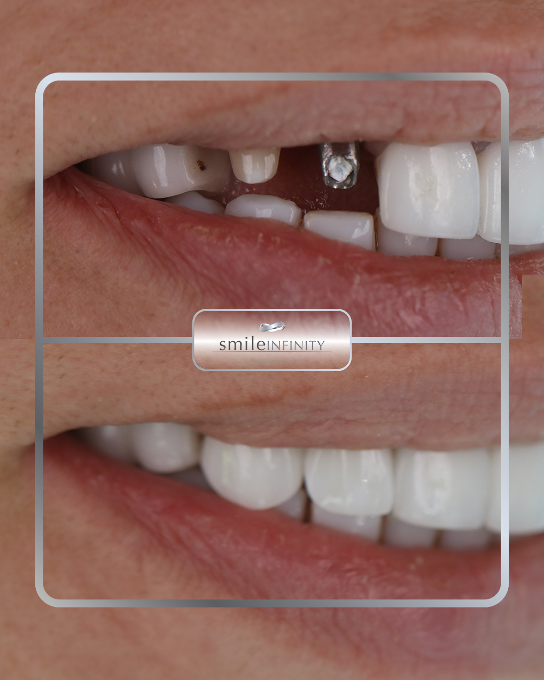 One Day Implant abutment placement before and after — Ferrari Dental Beirut Lebanon by Dr. Habib Zarifeh
