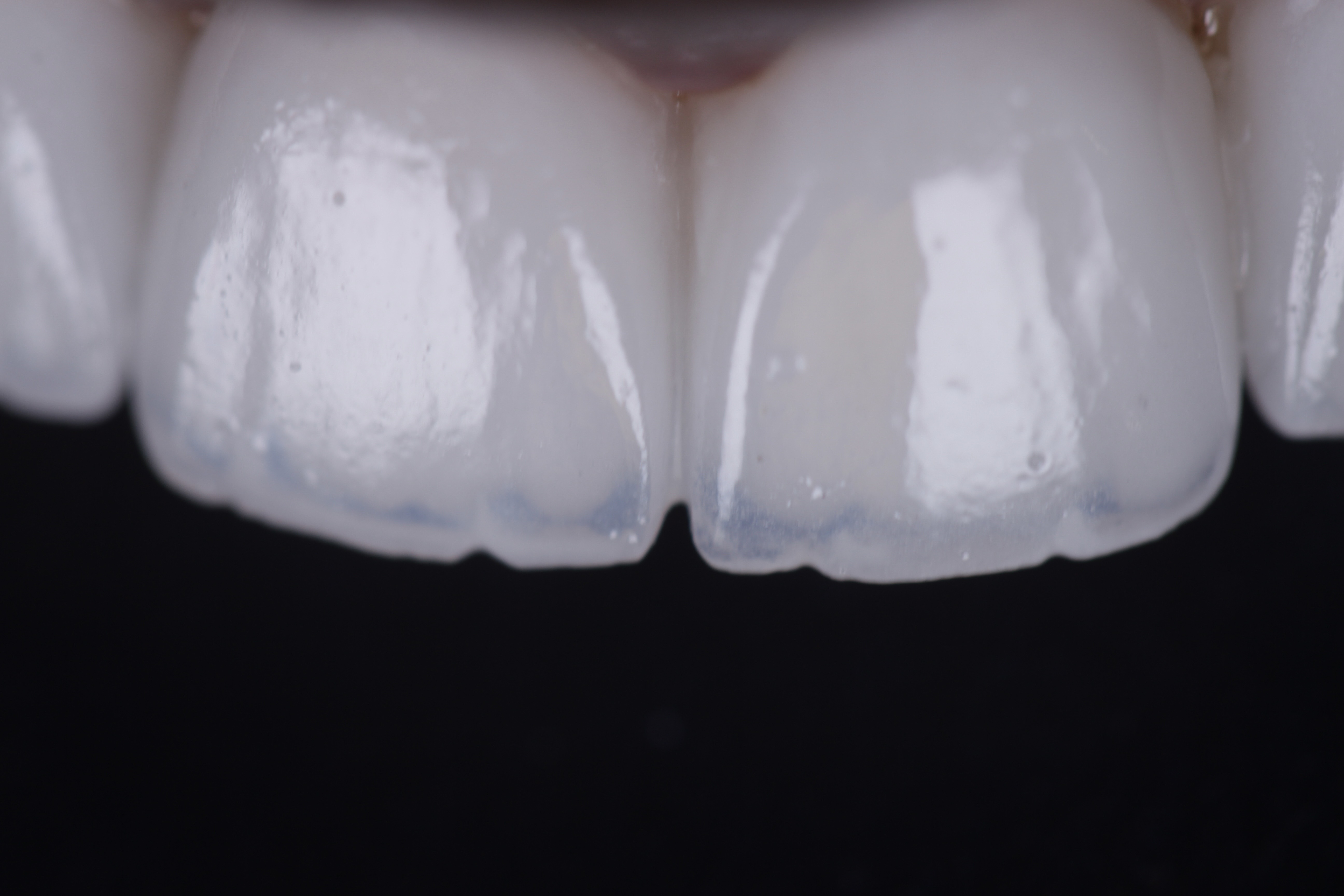 Porcelain veneers close-up upper arch — Smile Infinity® Lebanon by Dr. Habib Zarifeh