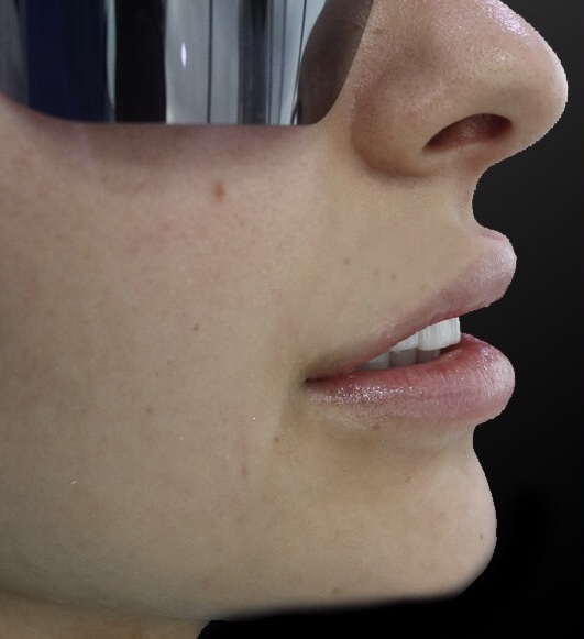 Smile Lift® after — restored lip support female patient side profile, Lebanon, Dr. Habib Zarifeh
