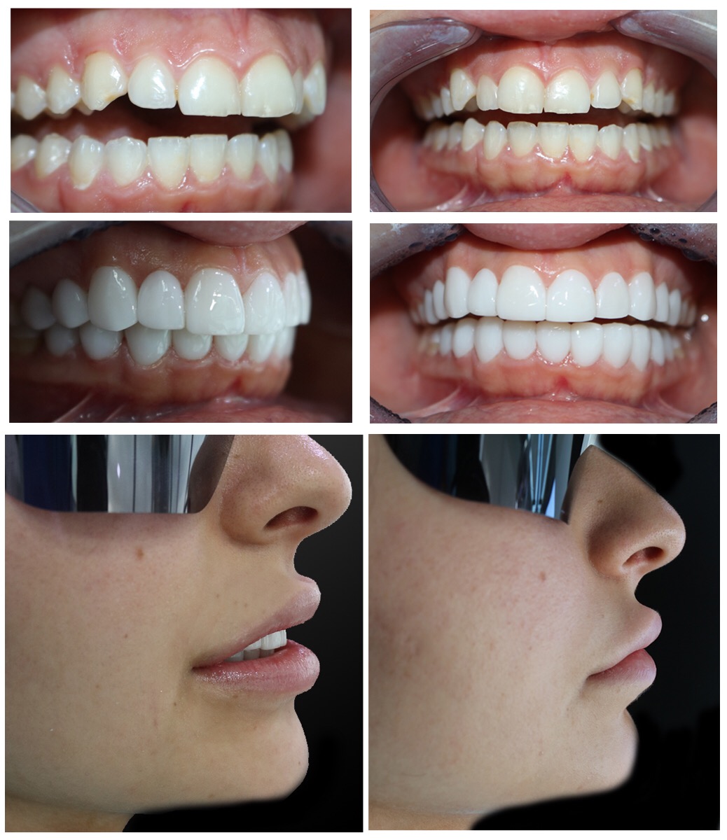 Smile Lift® six-panel composite — teeth before after and facial profile transformation, female patient Lebanon