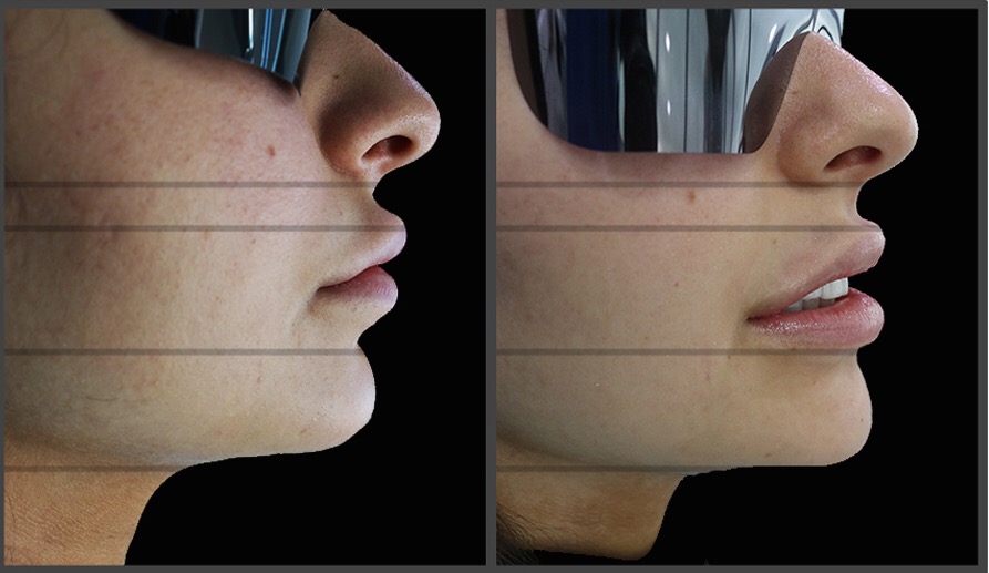 Smile Lift® before and after facial profile comparison — female patient, Smile Infinity® Lebanon by Dr. Habib Zarifeh