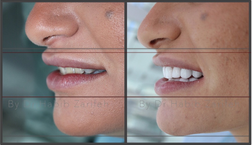 Smile Lift® facial rejuvenation before and after — by Dr. Habib Zarifeh, Lebanon