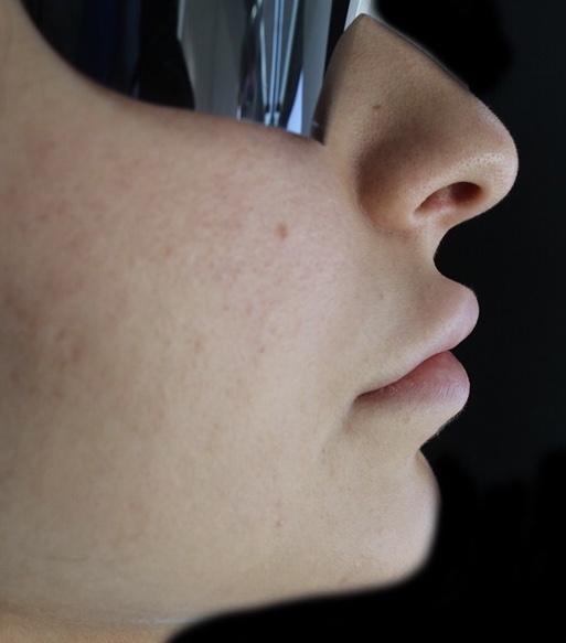 Smile Lift® before — collapsed lips female patient side profile, Lebanon, Dr. Habib Zarifeh