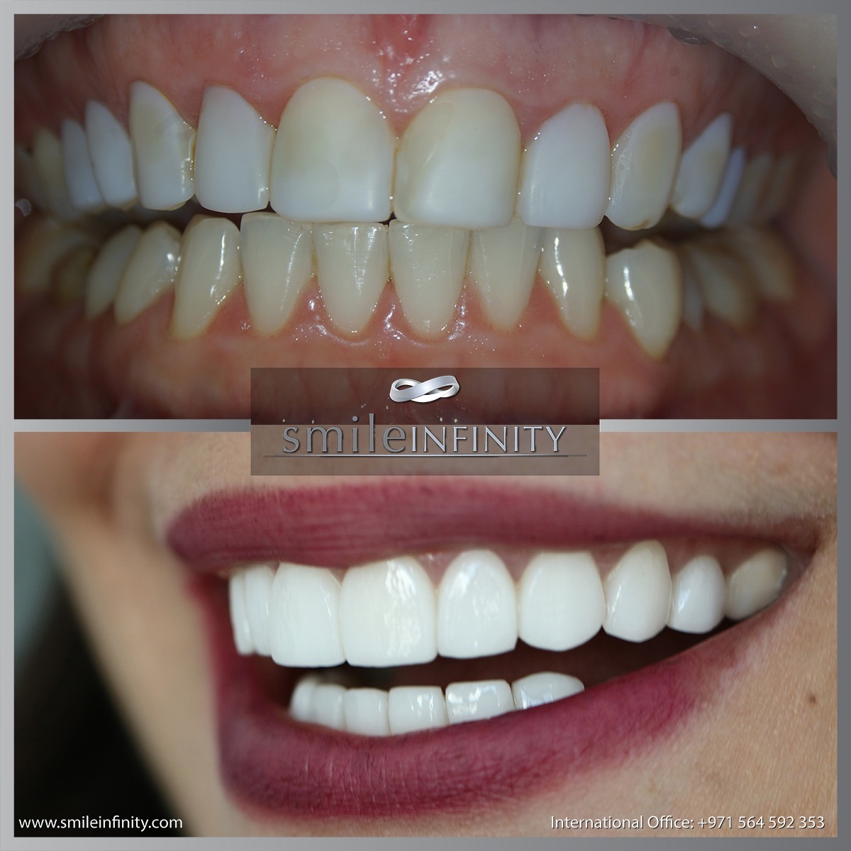 Smile Lift® with veneers before and after Hollywood Smile — Smile Infinity® Lebanon