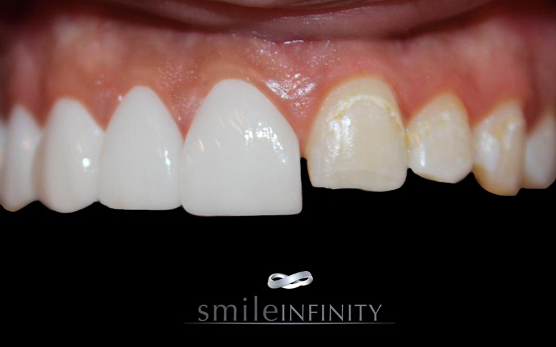 Smile Lift® veneers placement during treatment — Smile Infinity® Lebanon by Dr. Habib Zarifeh