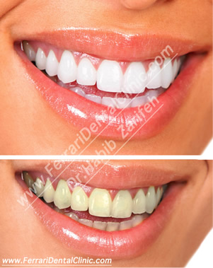 Teeth whitening before and after — Hollywood Smile, Ferrari Dental Clinic Beirut Lebanon by Dr. Habib Zarifeh