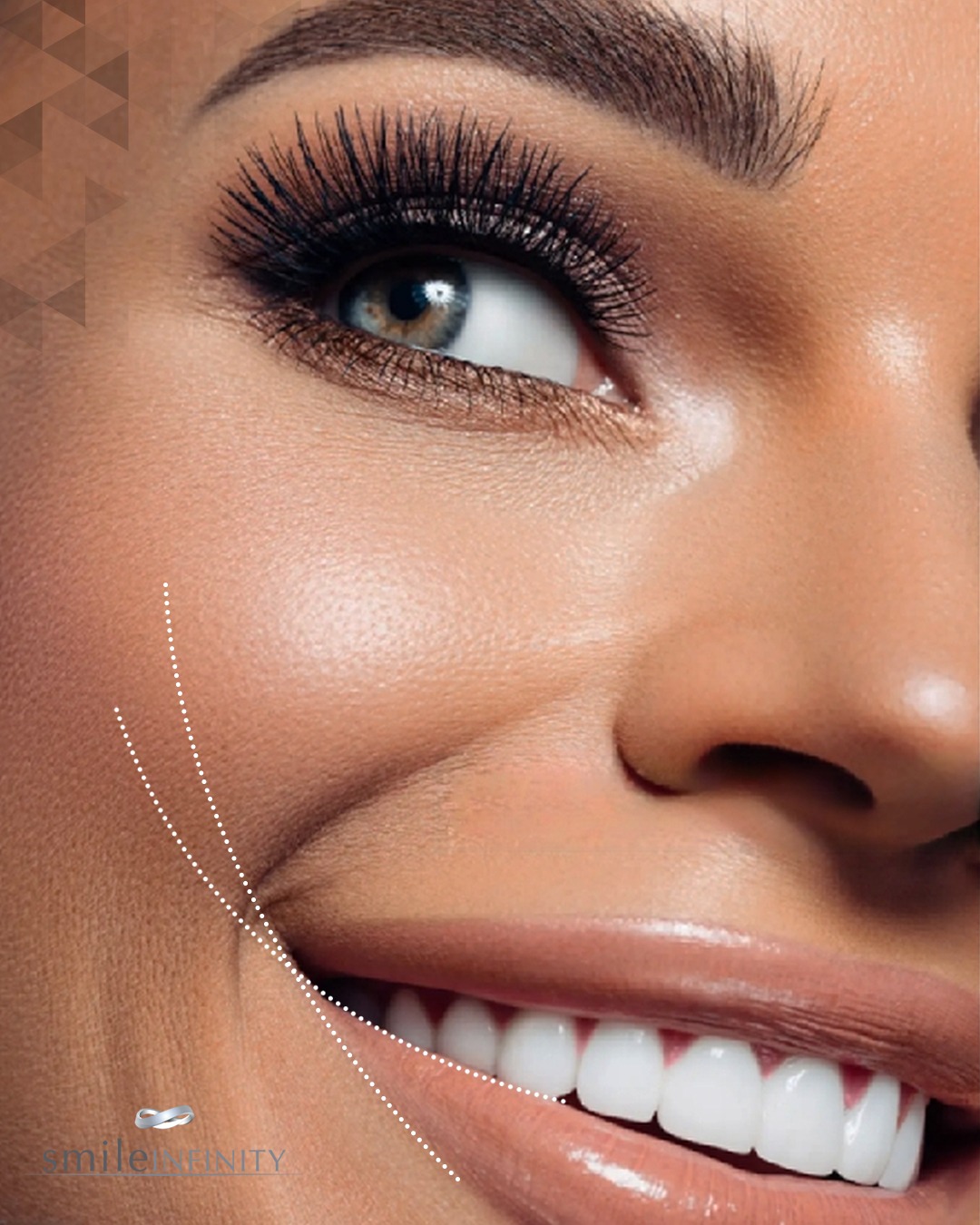 Laser teeth whitening Lebanon — perfect white smile by Smile Infinity®, Dr. Habib Zarifeh