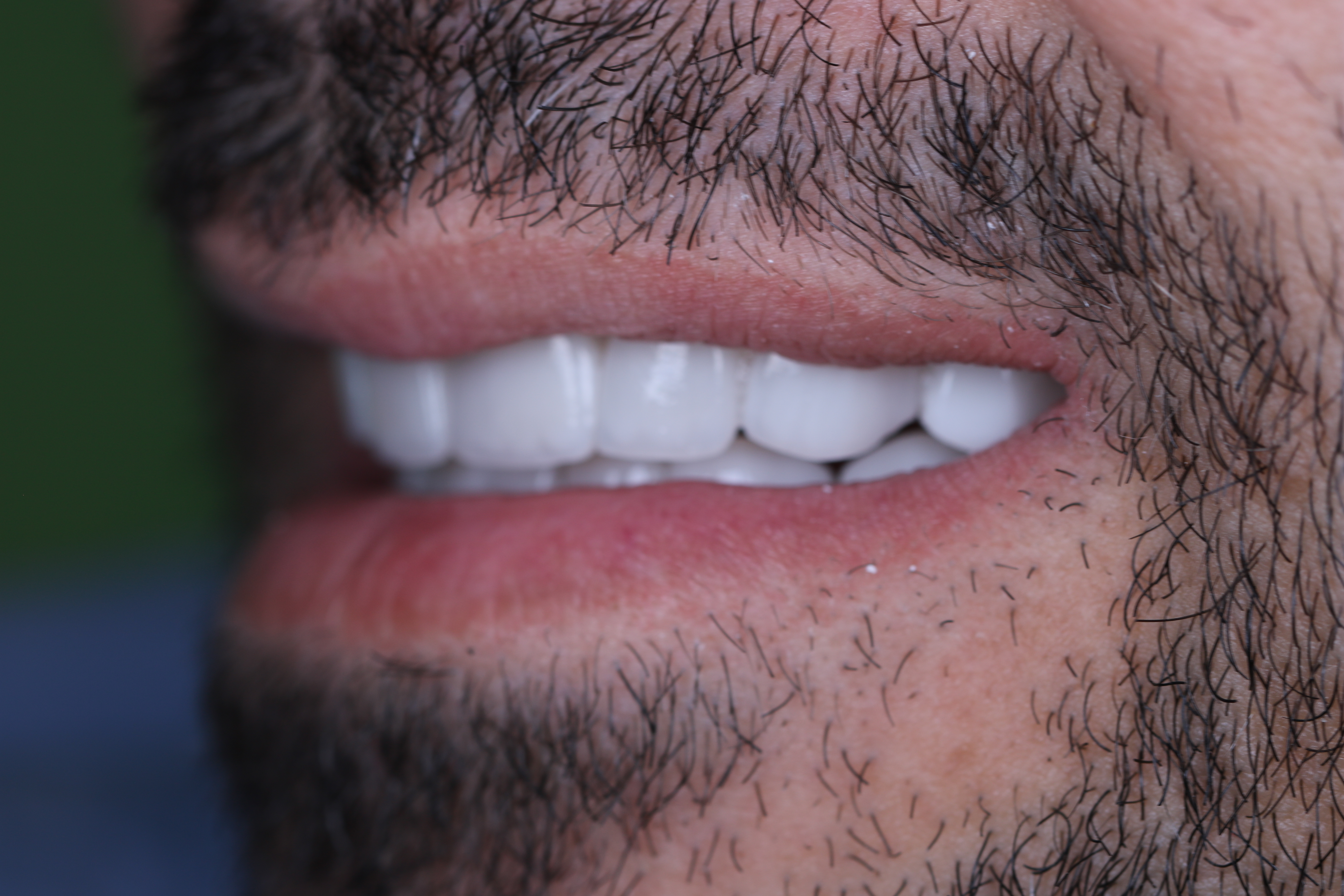 Veneers after close-up teeth — male patient, Lebanon, Smile Infinity®, Case 2