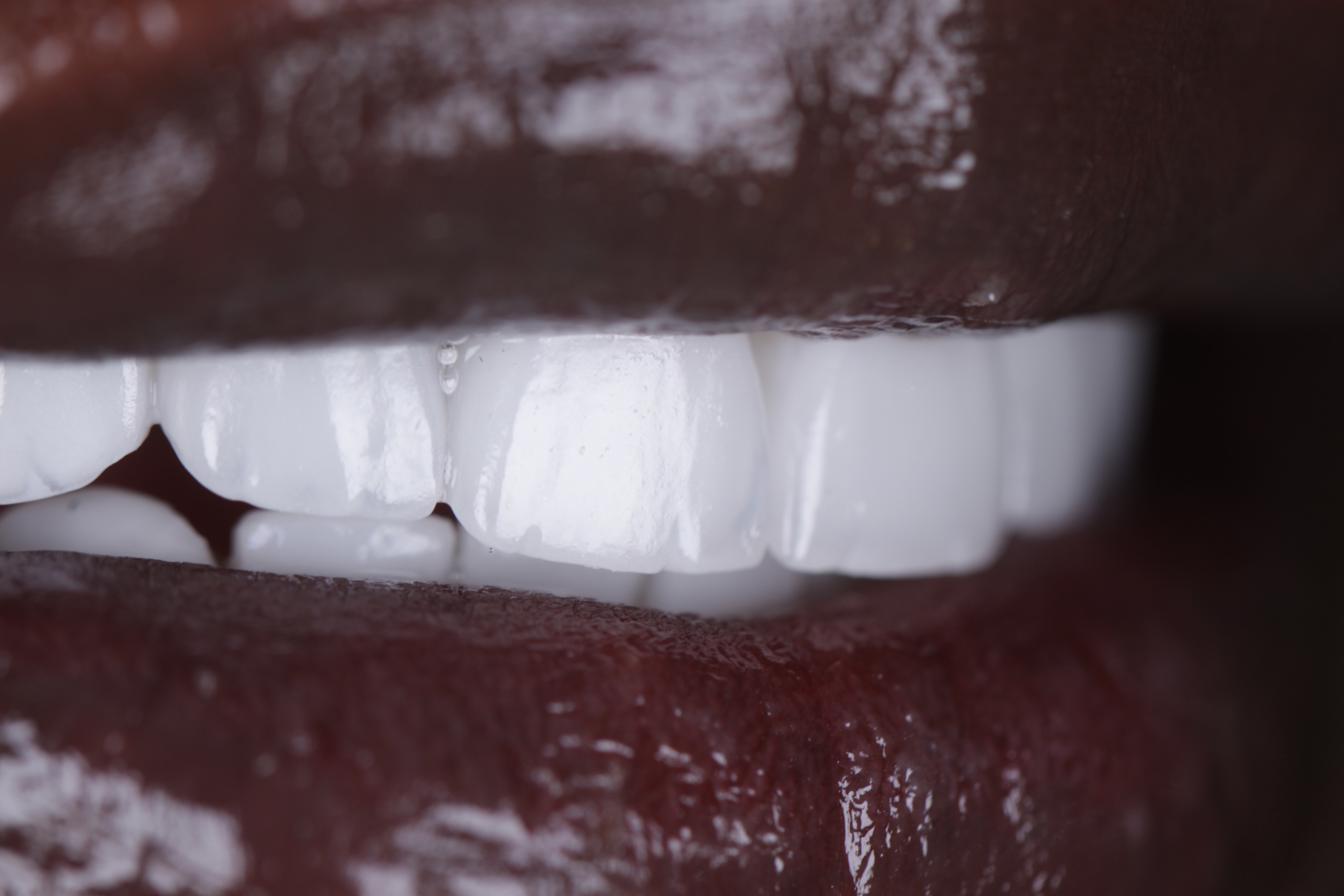 Veneers after close-up white smile — African patient, Smile Infinity® Abidjan Lebanon, Case 1