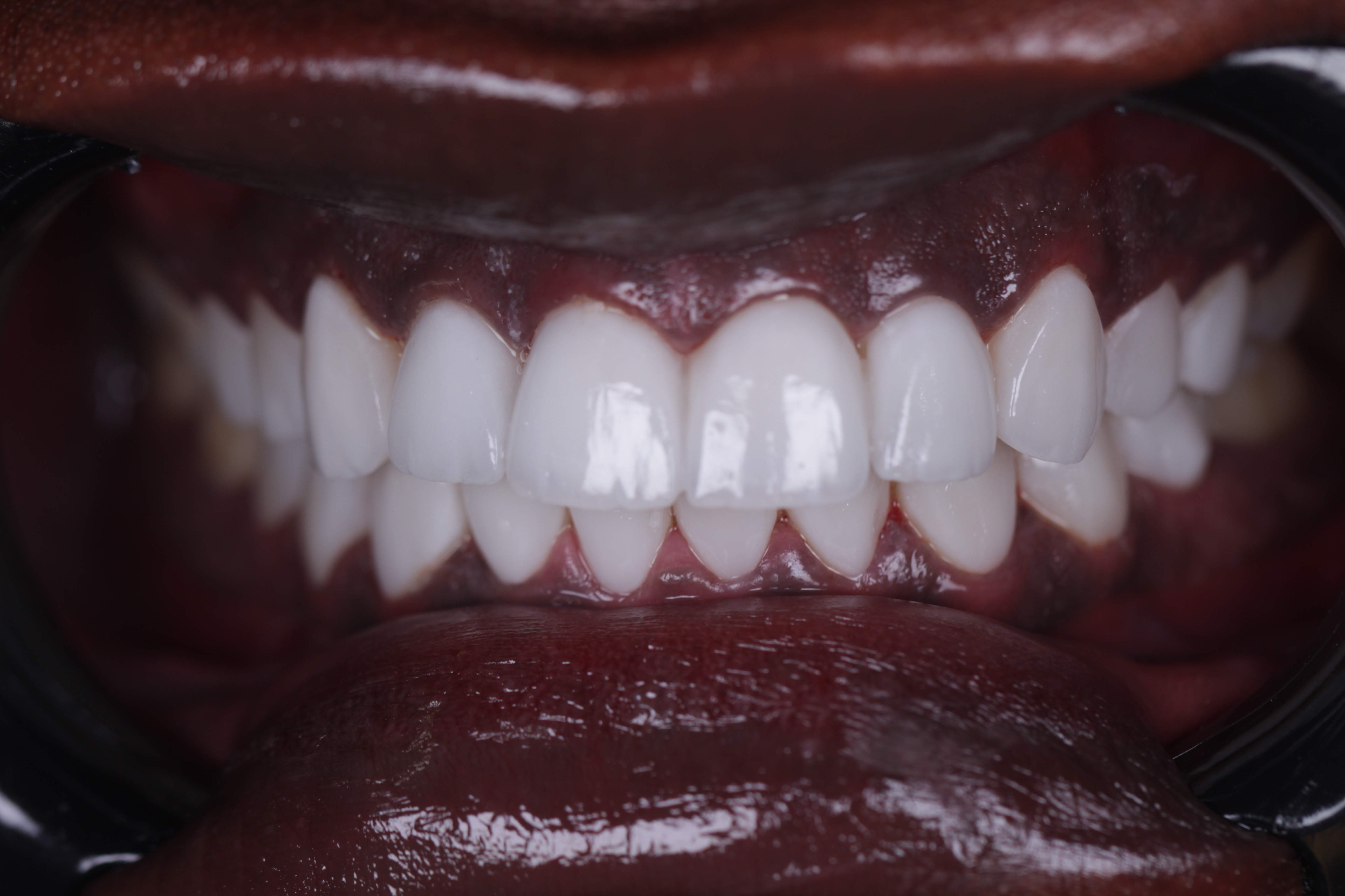 Veneers after full arch with retractor — African patient, Smile Infinity® Abidjan Lebanon, Case 1