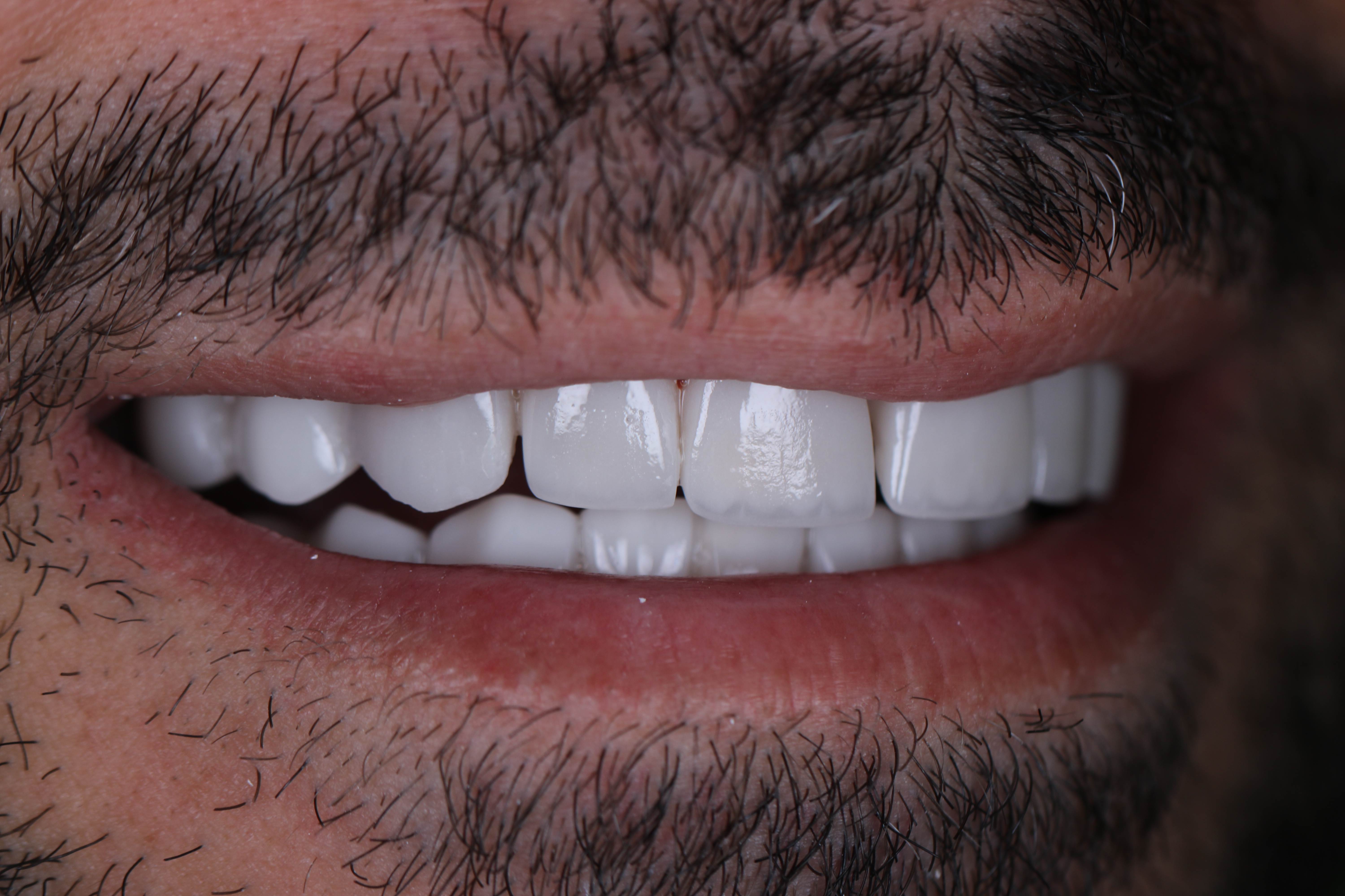 Veneers after full smile — male patient, Lebanon, Smile Infinity®, Case 2