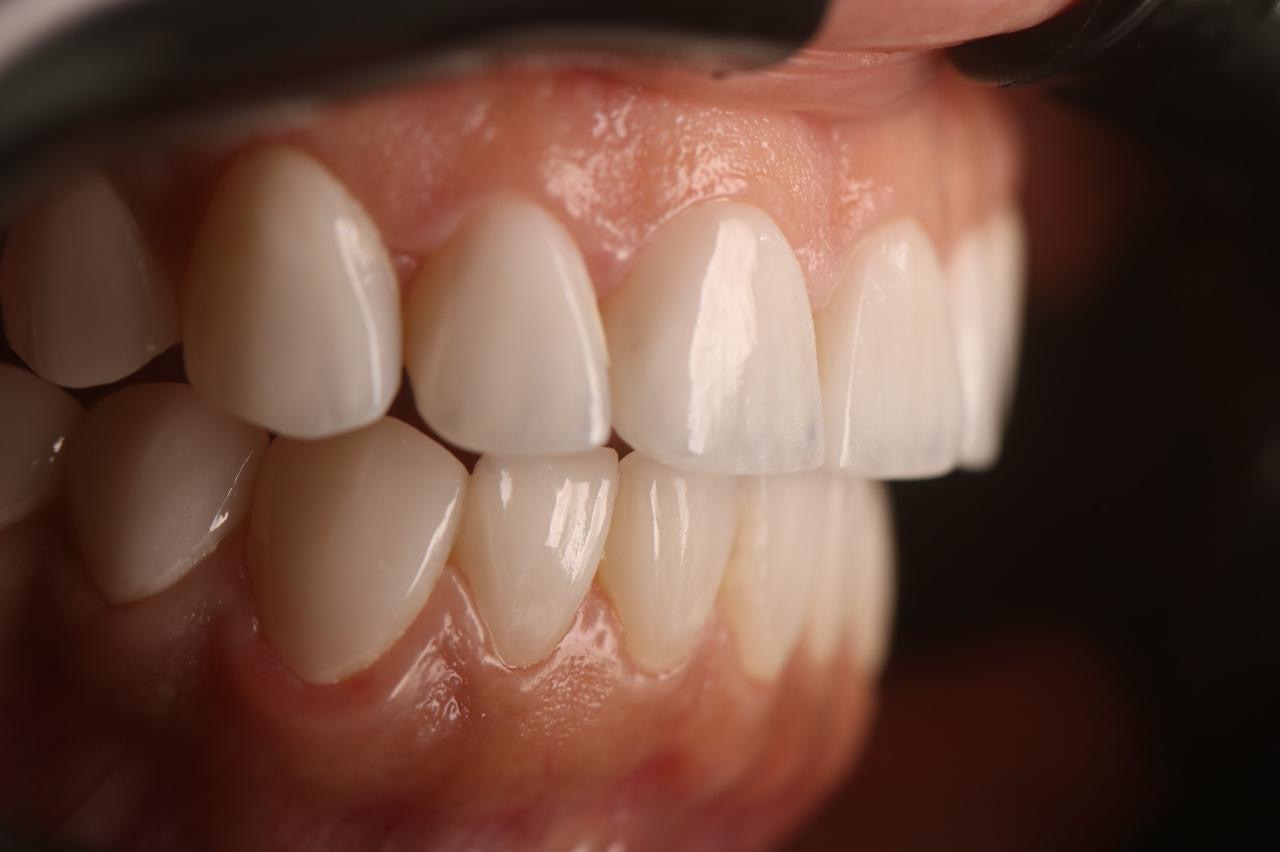 Veneers after lateral occlusal view — female patient, Smile Infinity® Lebanon, Case 3