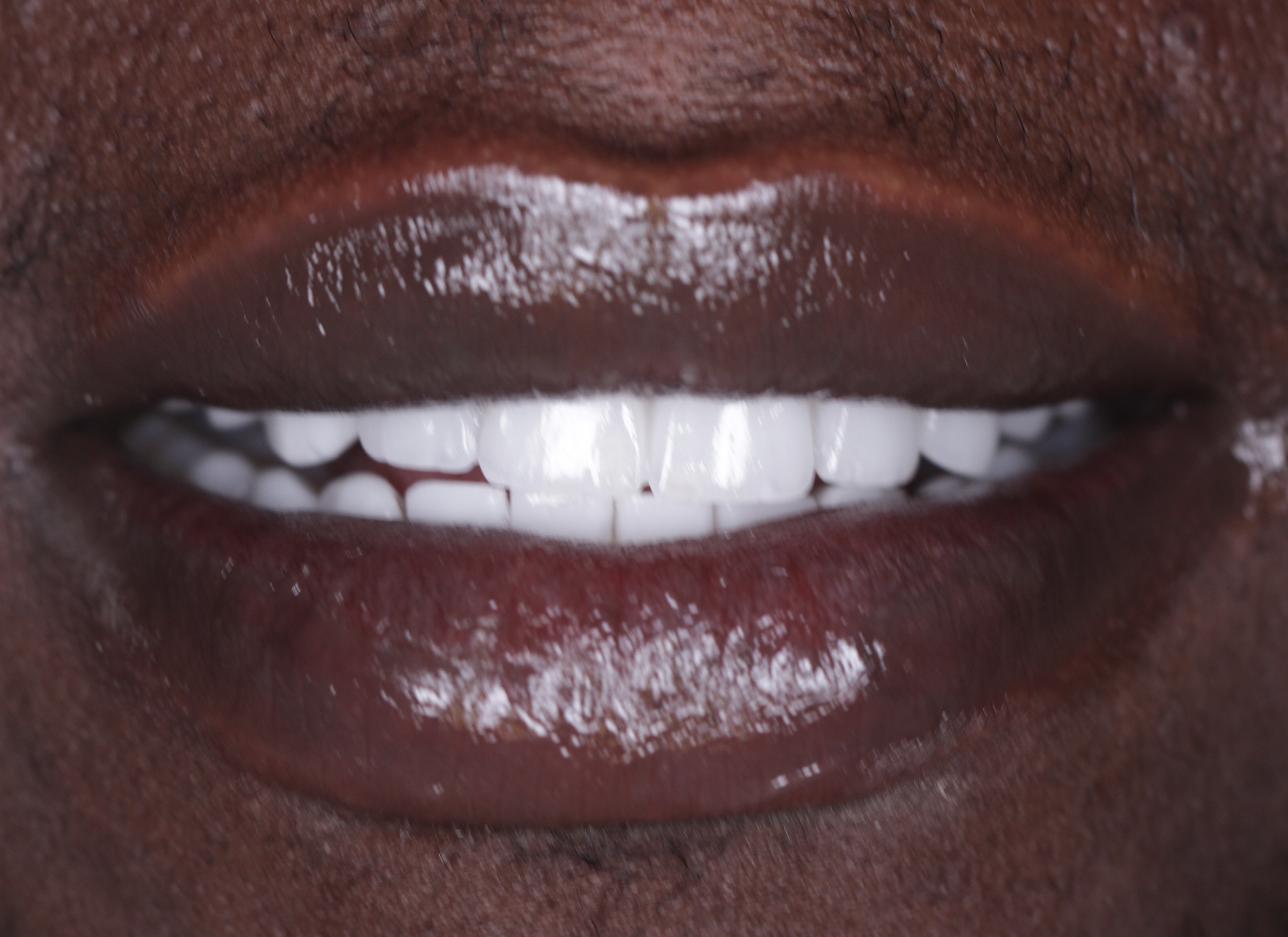 Veneers after smile result — African patient, Smile Infinity® Abidjan Lebanon, Case 1