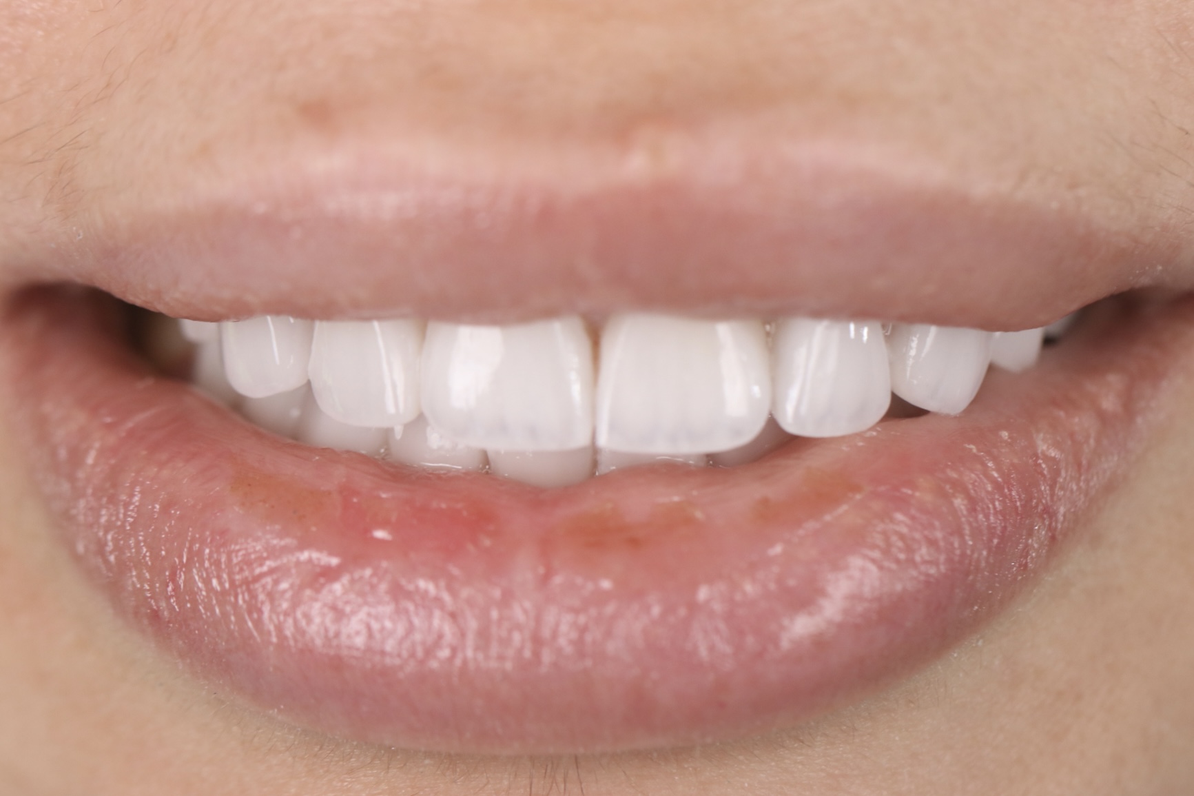 Veneers after smile result — female patient, Smile Infinity® Lebanon, Case 3