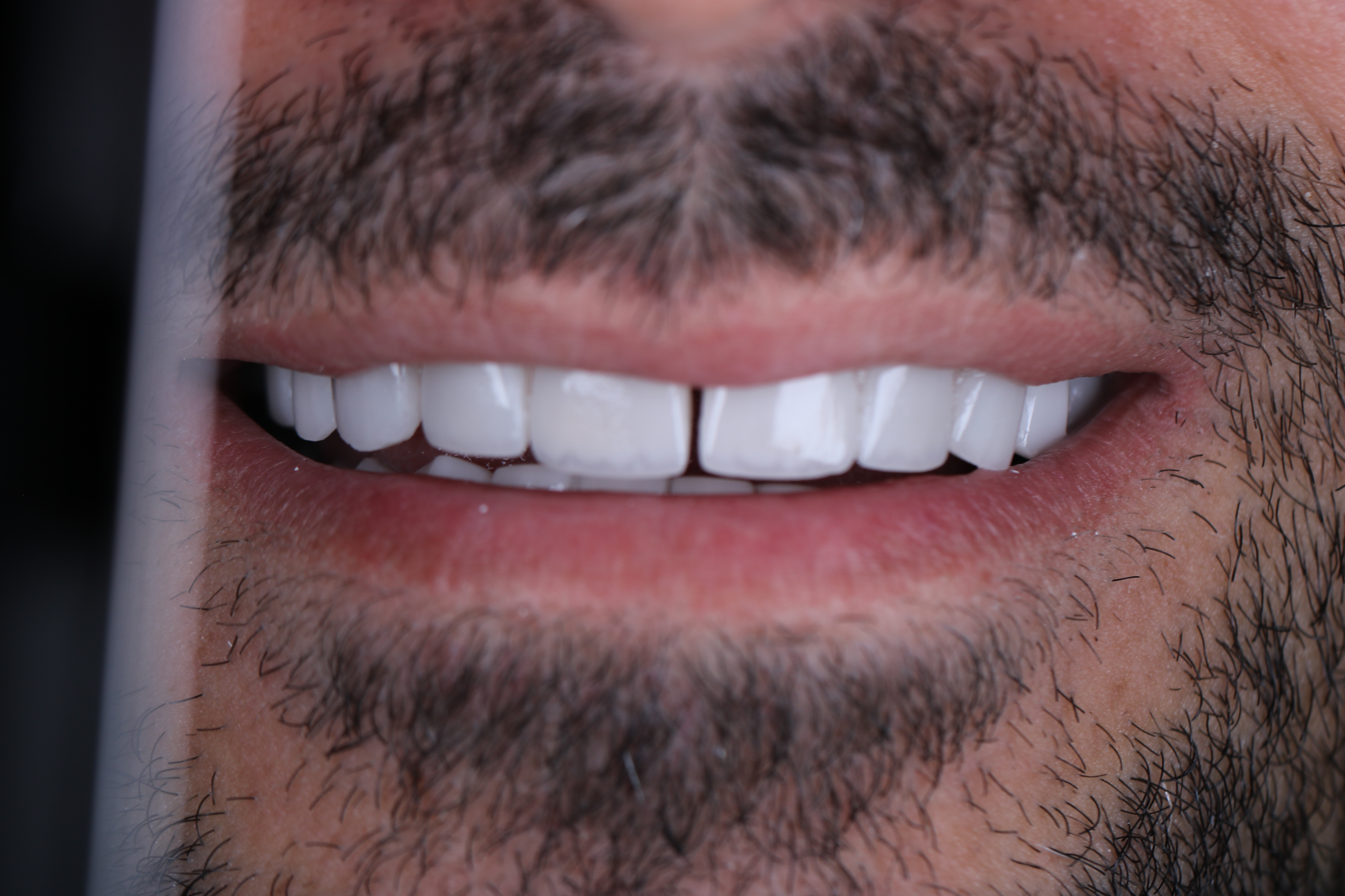 Veneers after smile result — male patient, Lebanon, Smile Infinity®, Case 2