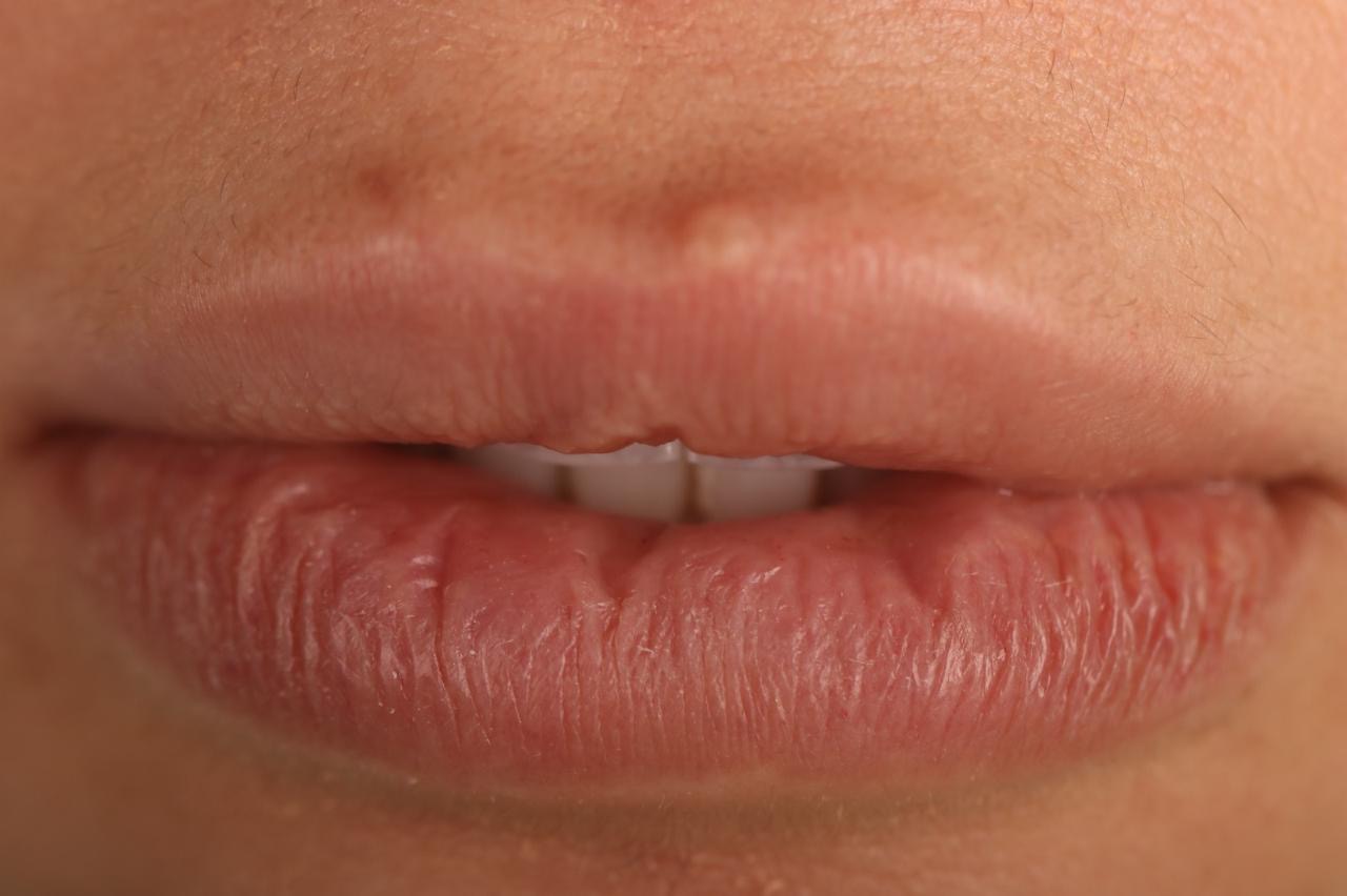 Veneers before — closed lips female patient, Smile Infinity® Lebanon, Case 3